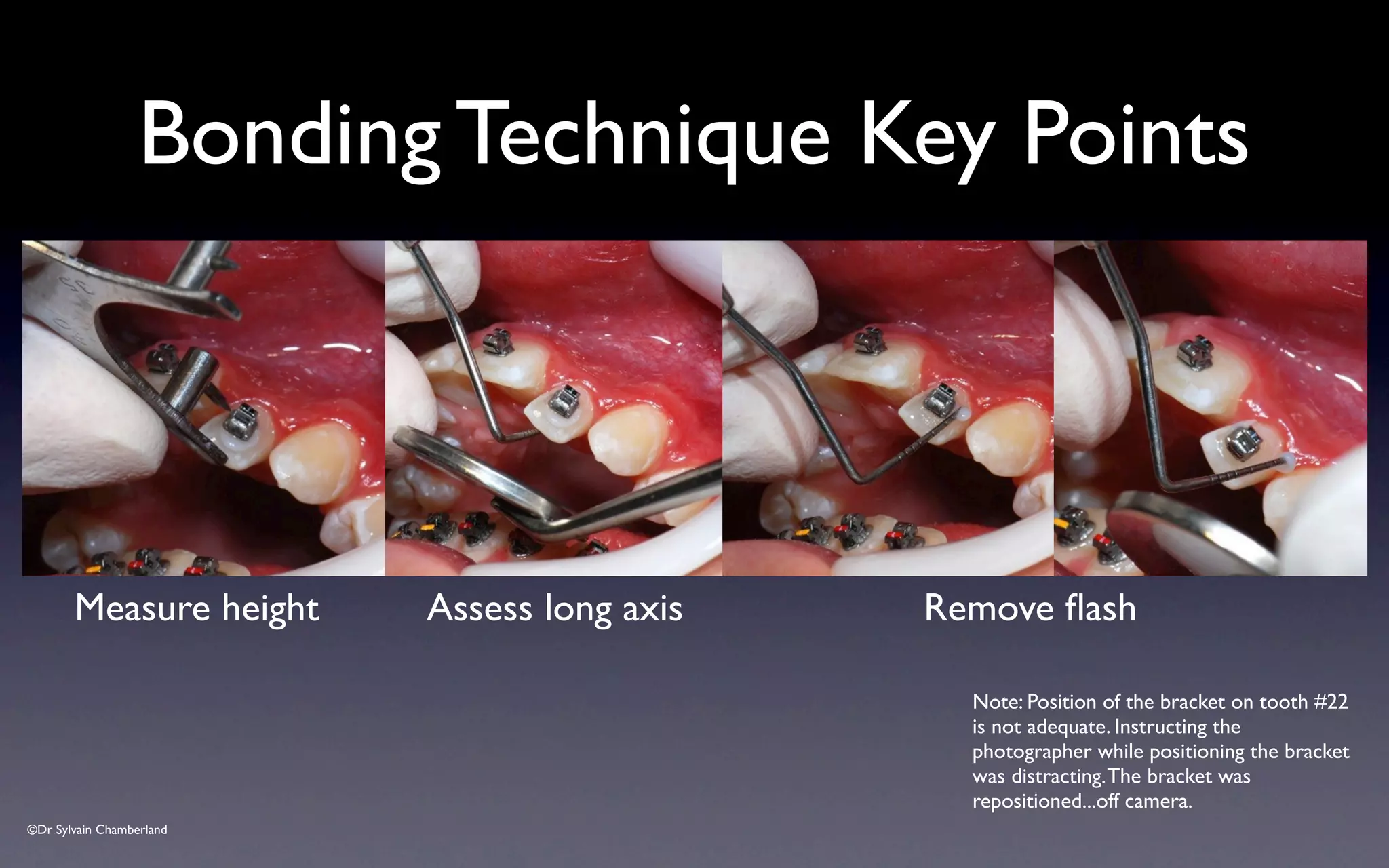 ©Dr Sylvain Chamberland
Bonding Technique Key Points
Measure height Assess long axis Remove flash
Note: Position of the bracket on tooth #22
is not adequate. Instructing the
photographer while positioning the bracket
was distracting.The bracket was
repositioned...off camera.
 