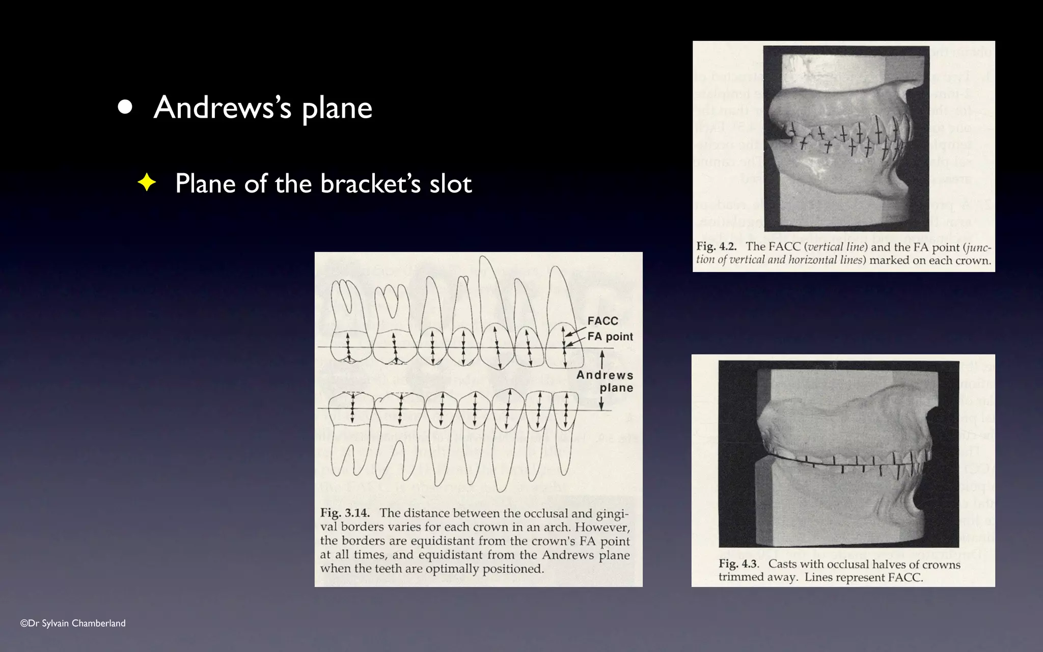 ©Dr Sylvain Chamberland
• Andrews’s plane
✦ Plane of the bracket’s slot
 