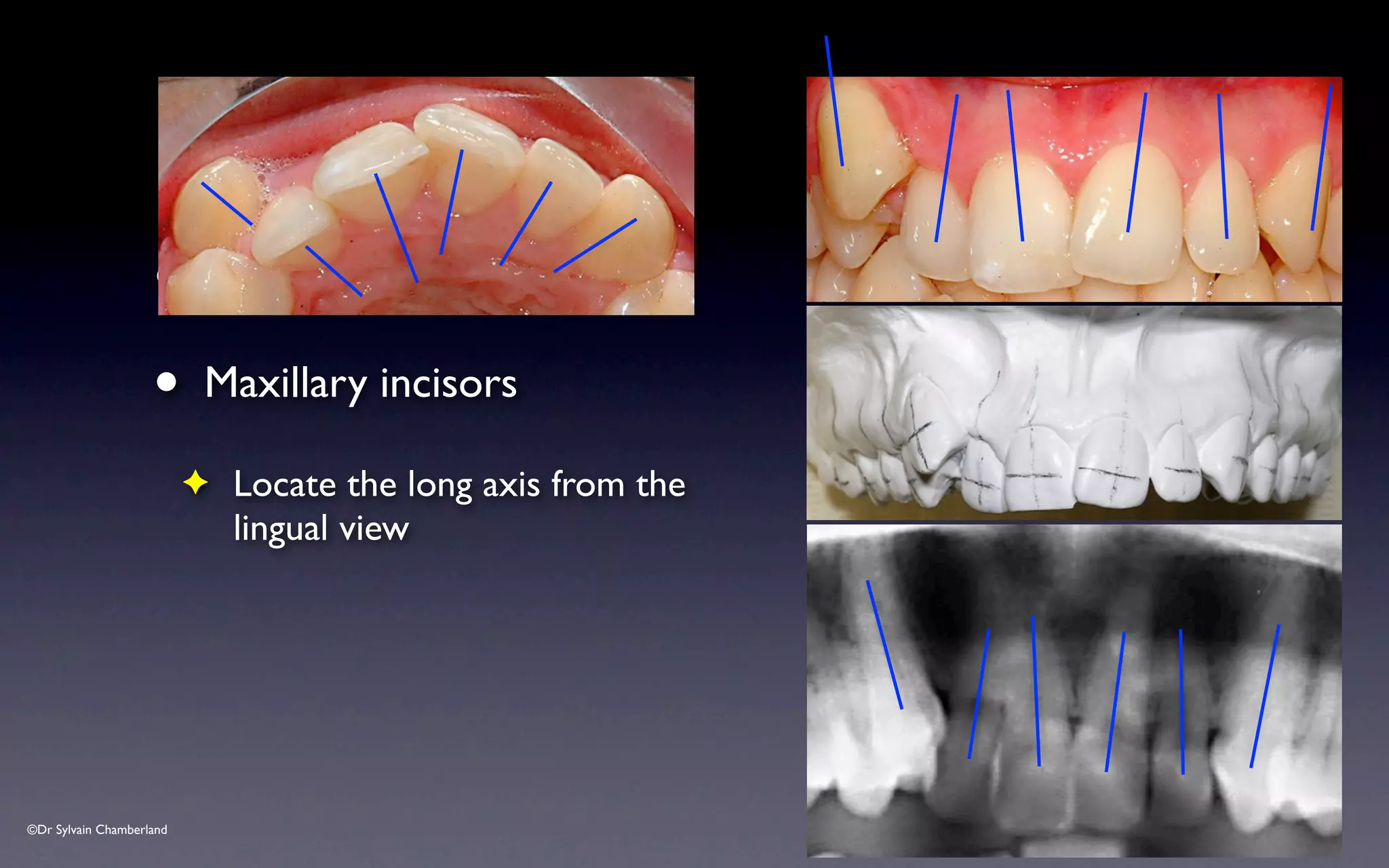 ©Dr Sylvain Chamberland
• C
• Maxillary incisors
✦ Locate the long axis from the
lingual view
 