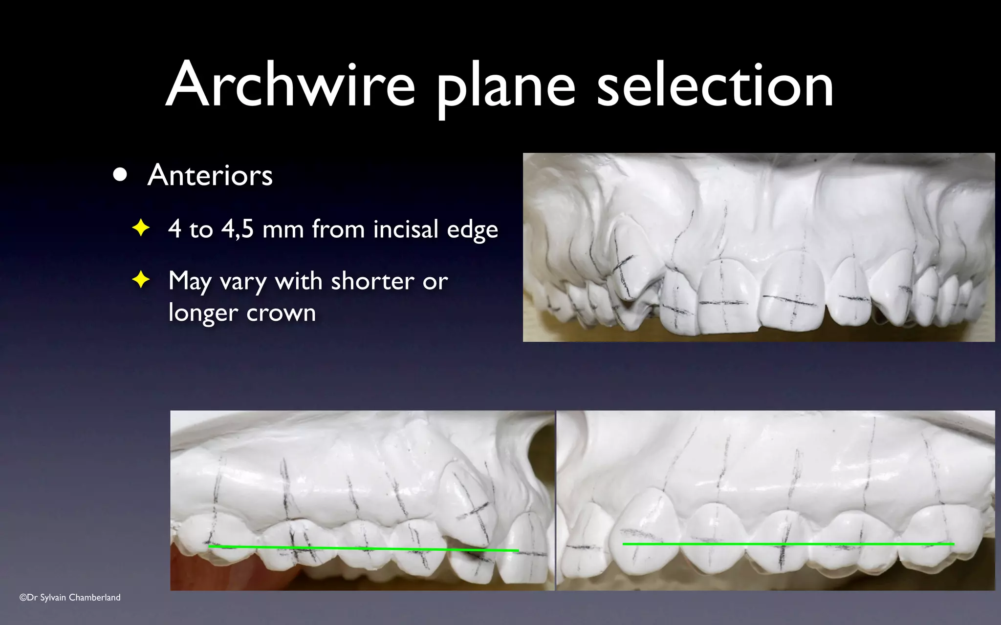 ©Dr Sylvain Chamberland
• Anteriors
✦ 4 to 4,5 mm from incisal edge
✦ May vary with shorter or
longer crown
Archwire plane selection
 