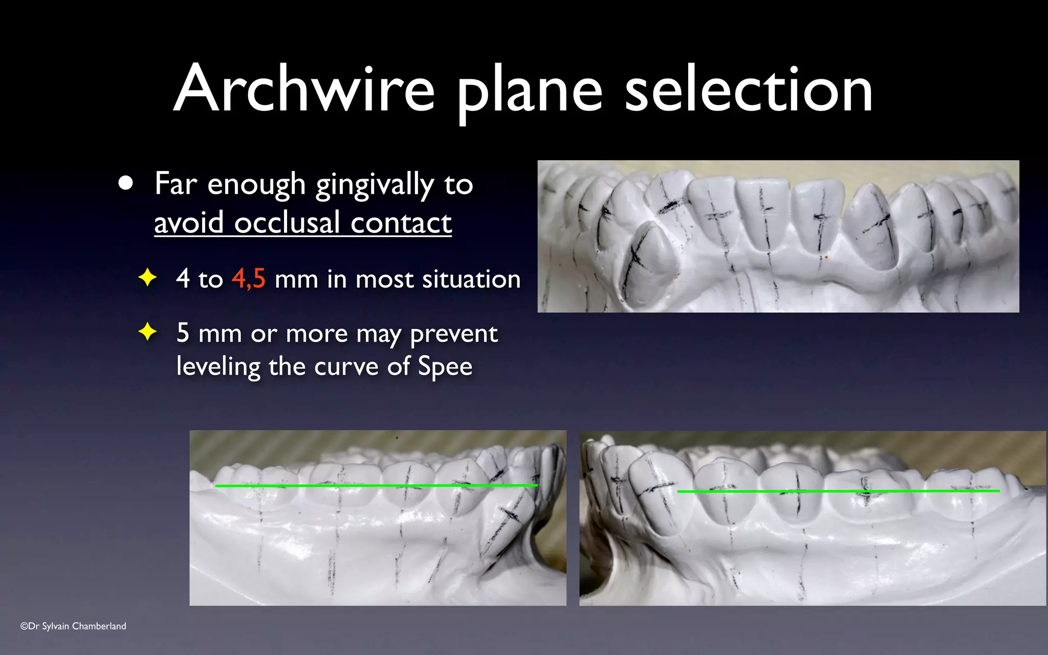©Dr Sylvain Chamberland
• Far enough gingivally to
avoid occlusal contact
✦ 4 to 4,5 mm in most situation
✦ 5 mm or more may prevent
leveling the curve of Spee
Archwire plane selection
 