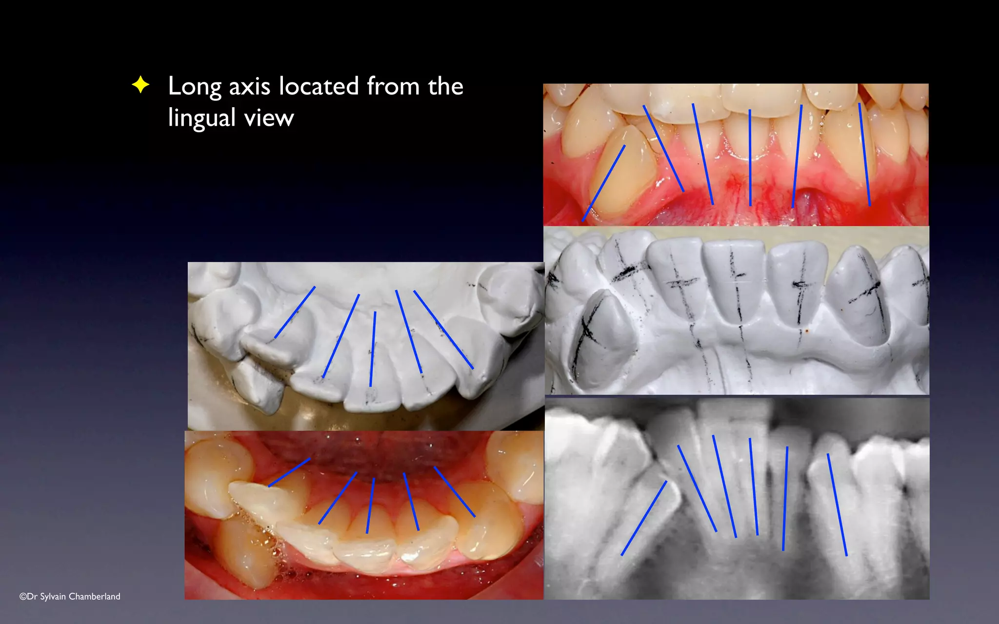©Dr Sylvain Chamberland
✦ Long axis located from the
lingual view
 