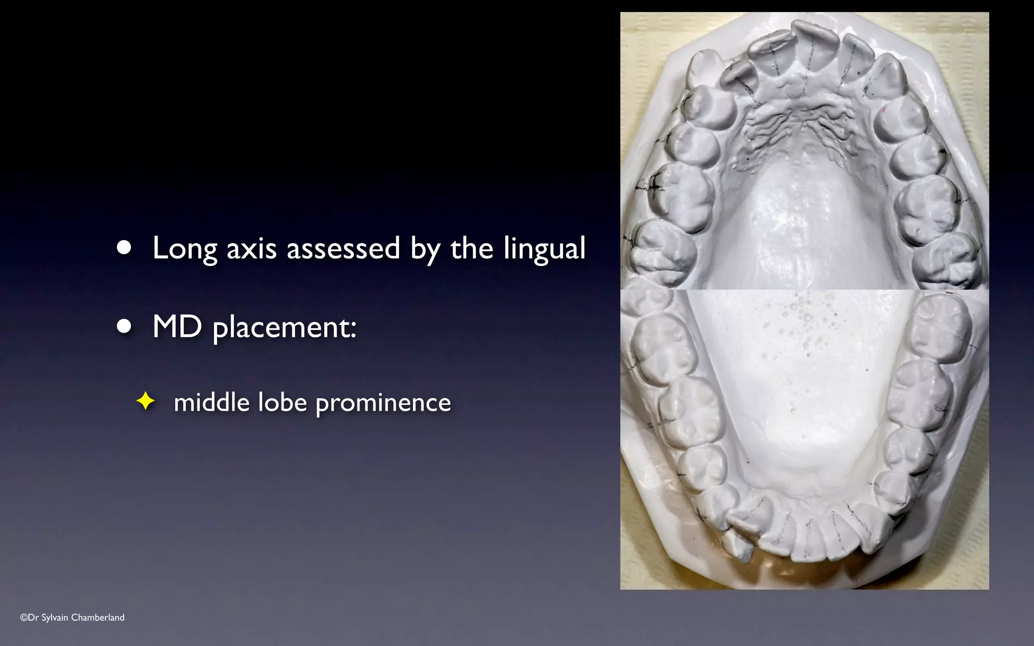 ©Dr Sylvain Chamberland
• Long axis assessed by the lingual
• MD placement:
✦ middle lobe prominence
 