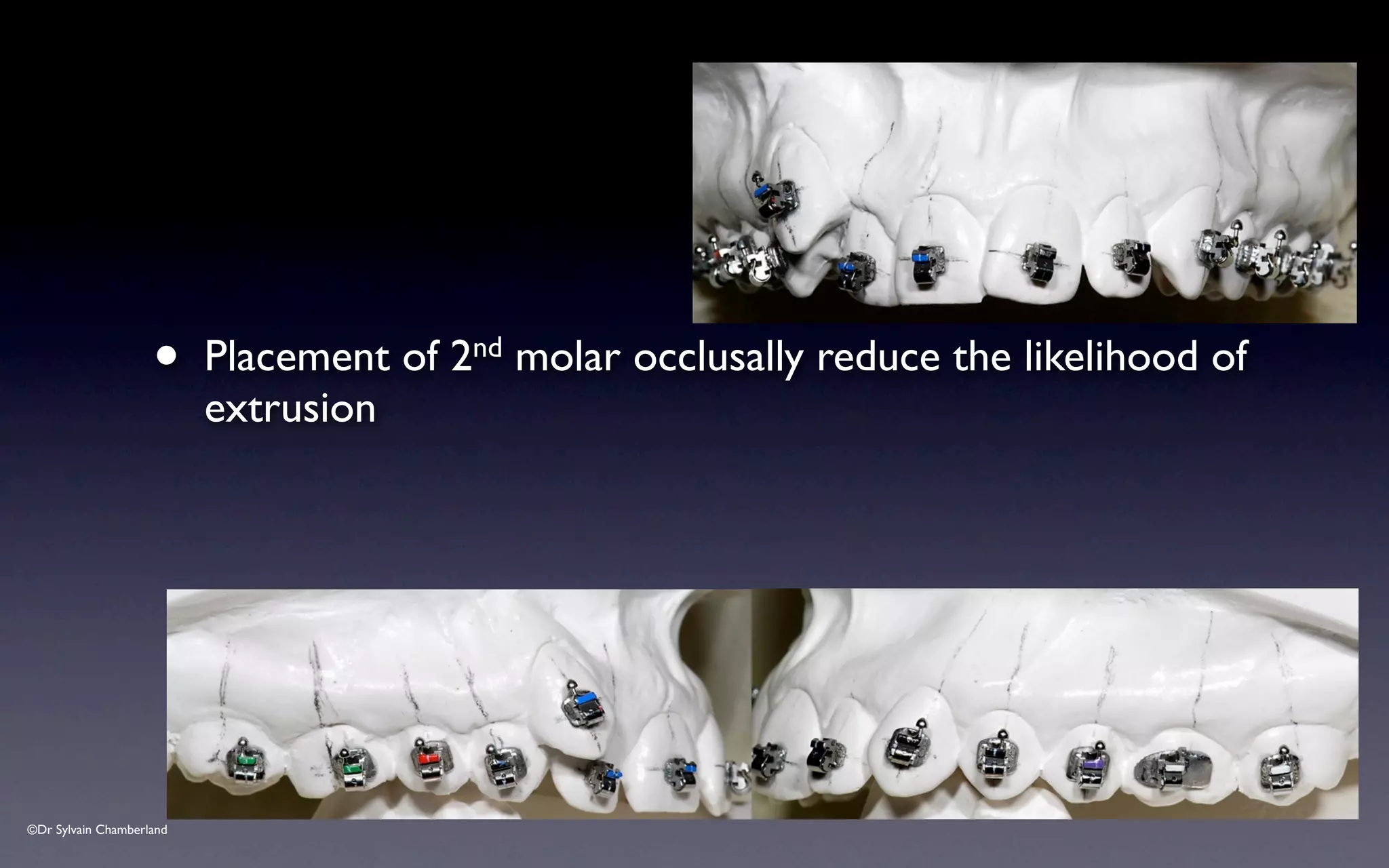 ©Dr Sylvain Chamberland
• Placement of 2nd molar occlusally reduce the likelihood of
extrusion
 
