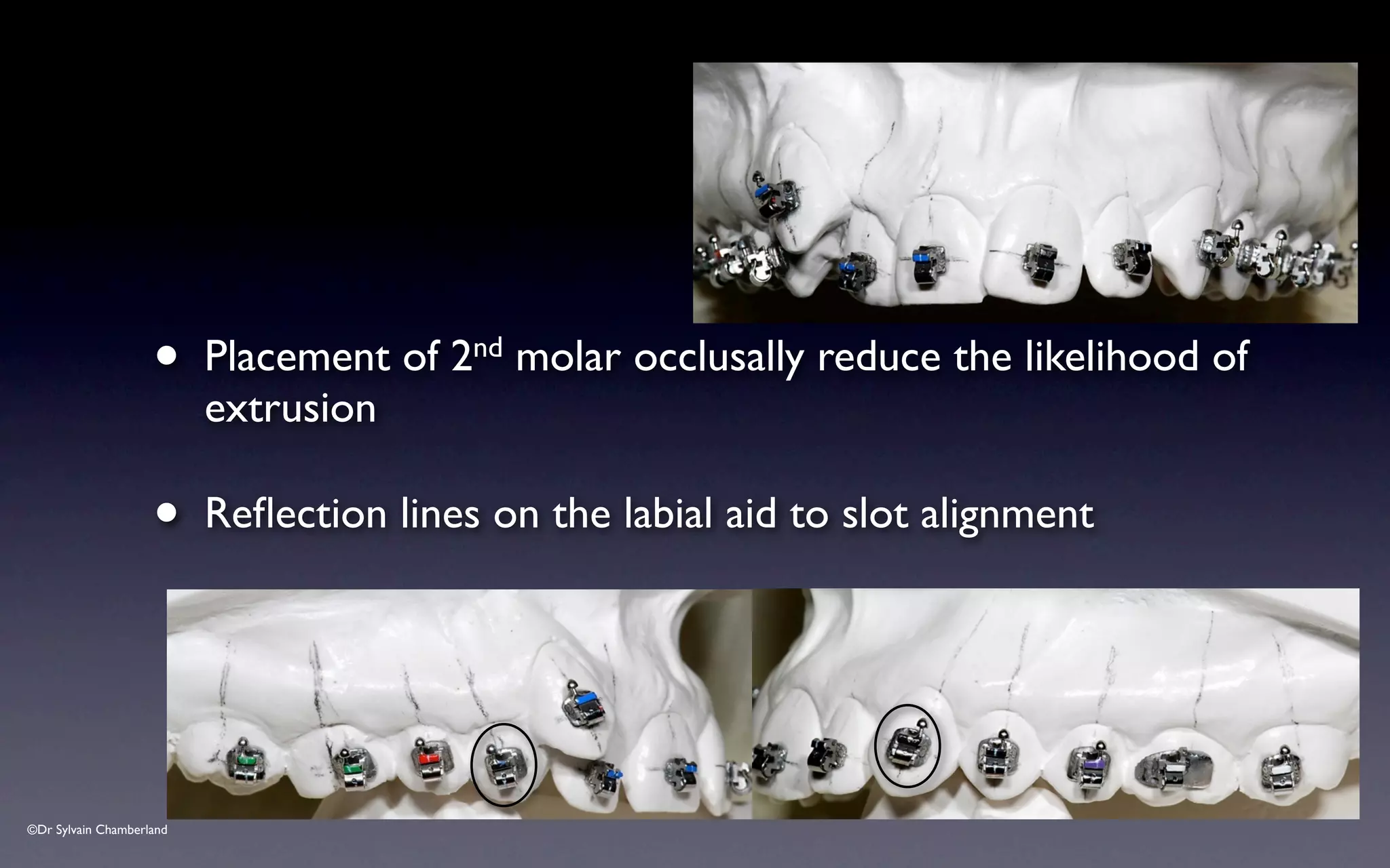 ©Dr Sylvain Chamberland
• Placement of 2nd molar occlusally reduce the likelihood of
extrusion
• Reflection lines on the labial aid to slot alignment
 