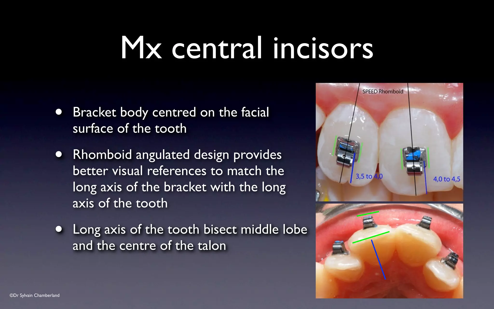 ©Dr Sylvain Chamberland
• Bracket body centred on the facial
surface of the tooth
• Rhomboid angulated design provides
better visual references to match the
long axis of the bracket with the long
axis of the tooth
• Long axis of the tooth bisect middle lobe
and the centre of the talon
Mx central incisors
4 to 4,5
 