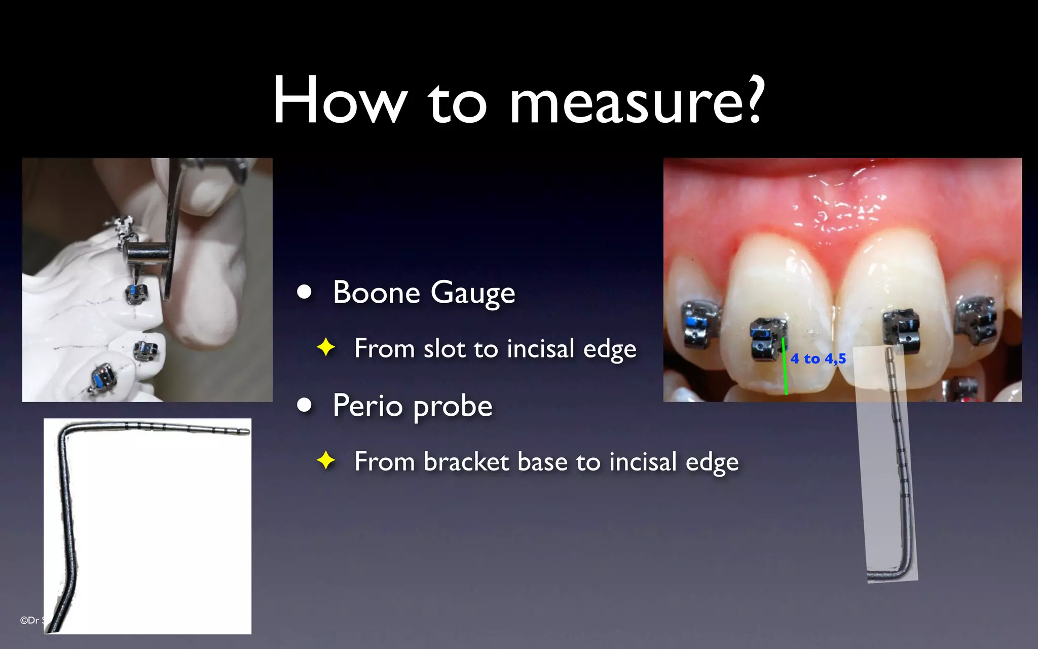©Dr Sylvain Chamberland
How to measure?
• Boone Gauge
✦ From slot to incisal edge
• Perio probe
✦ From bracket base to incisal edge
4 to 4,5
 