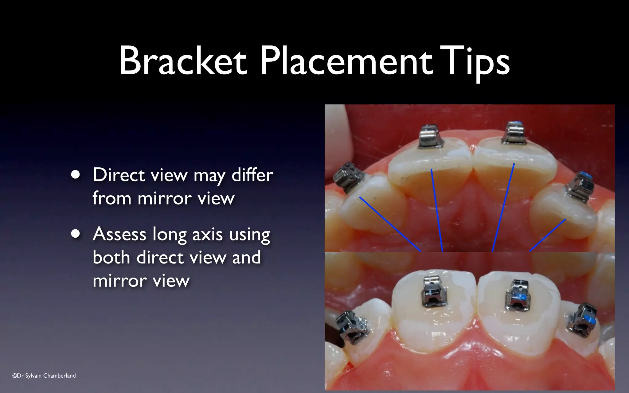 ©Dr Sylvain Chamberland
Bracket Placement Tips
• Direct view may differ
from mirror view
• Assess long axis using
both direct view and
mirror view
 