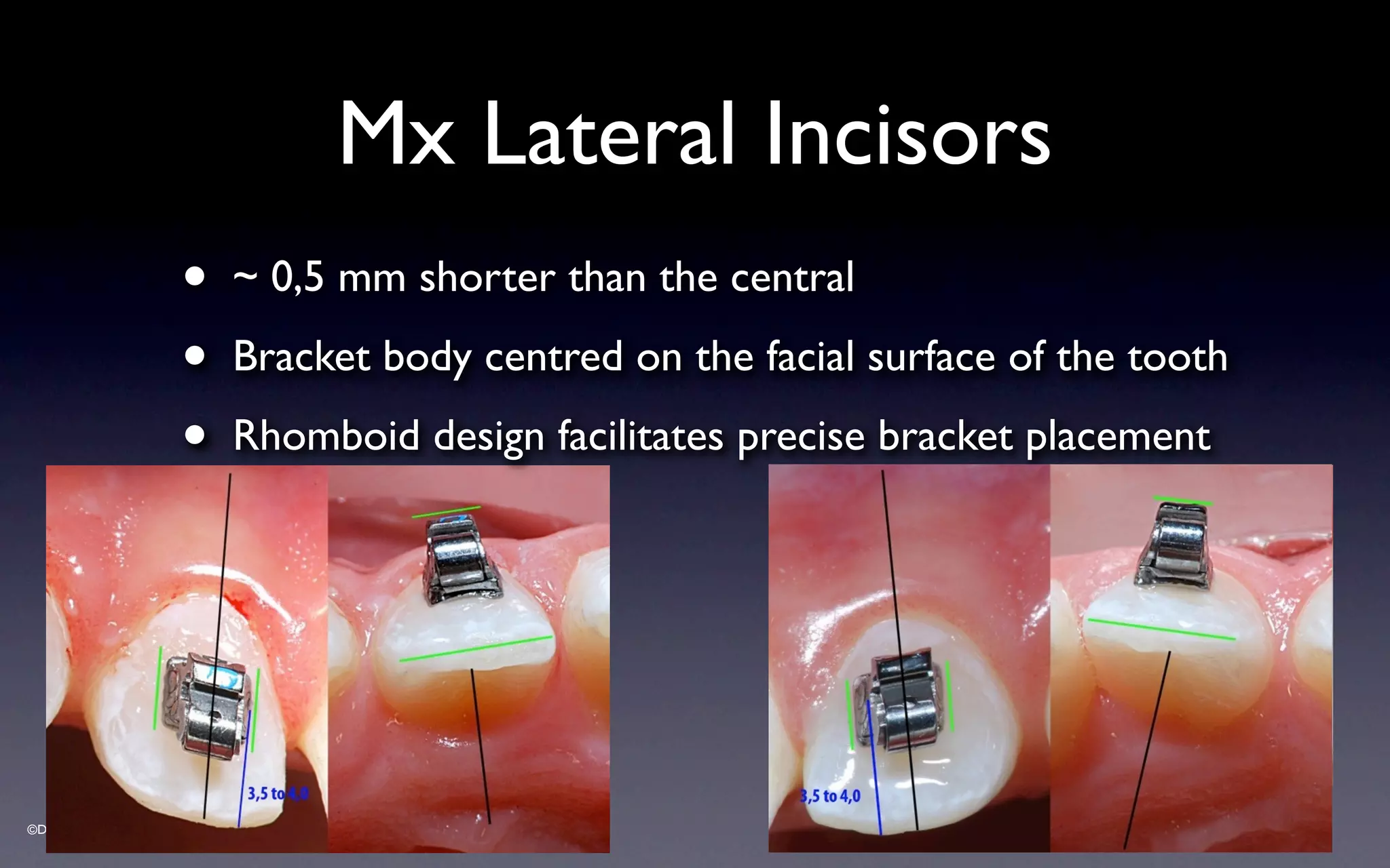 ©Dr Sylvain Chamberland
Mx Lateral Incisors
• ~ 0,5 mm shorter than the central
• Bracket body centred on the facial surface of the tooth
• Rhomboid design facilitates precise bracket placement
 
