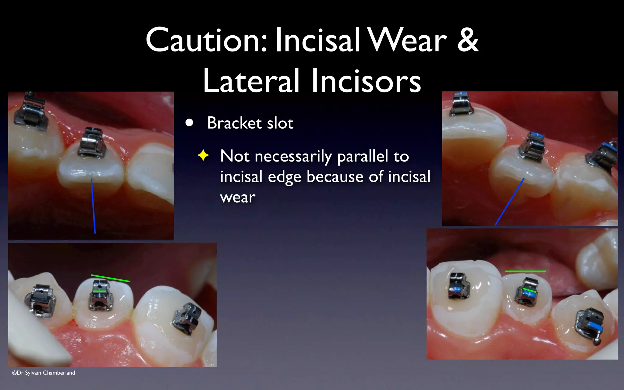 ©Dr Sylvain Chamberland
• Bracket slot
✦ Not necessarily parallel to
incisal edge because of incisal
wear
Caution: Incisal Wear &
Lateral Incisors
 