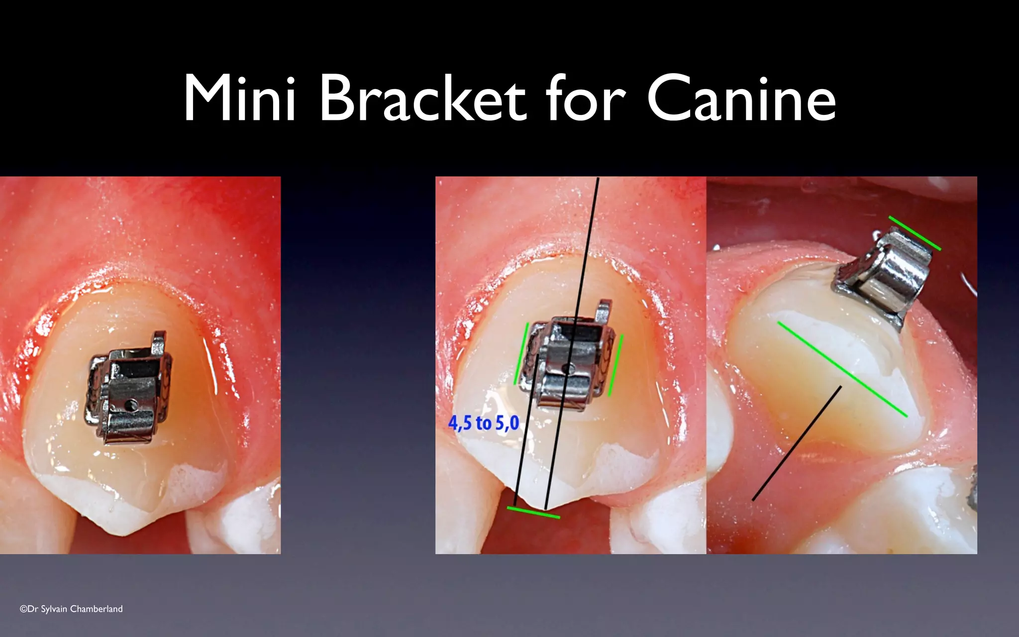 ©Dr Sylvain Chamberland
Mini Bracket for Canine
 