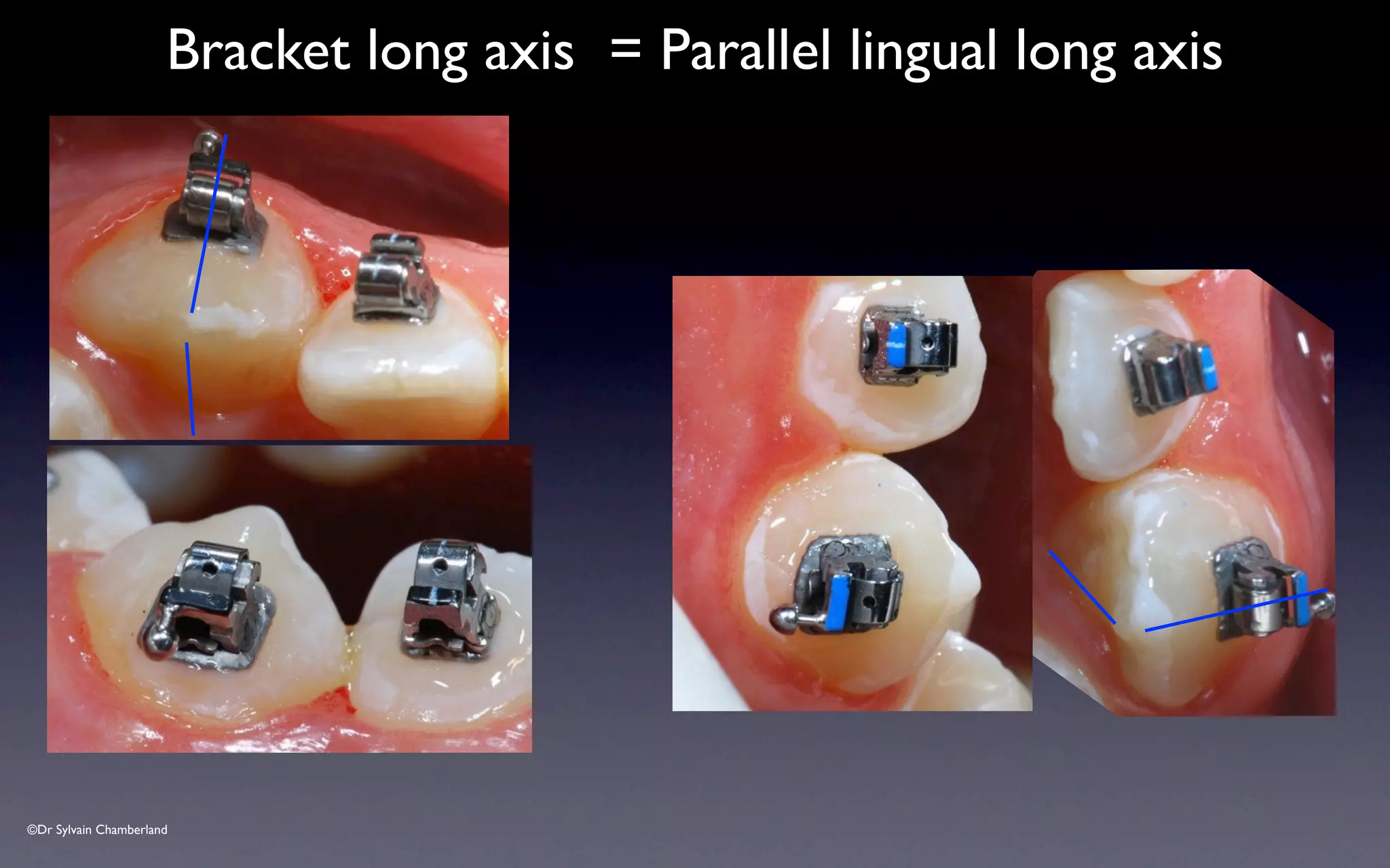 ©Dr Sylvain Chamberland
Bracket long axis = Parallel lingual long axis
 