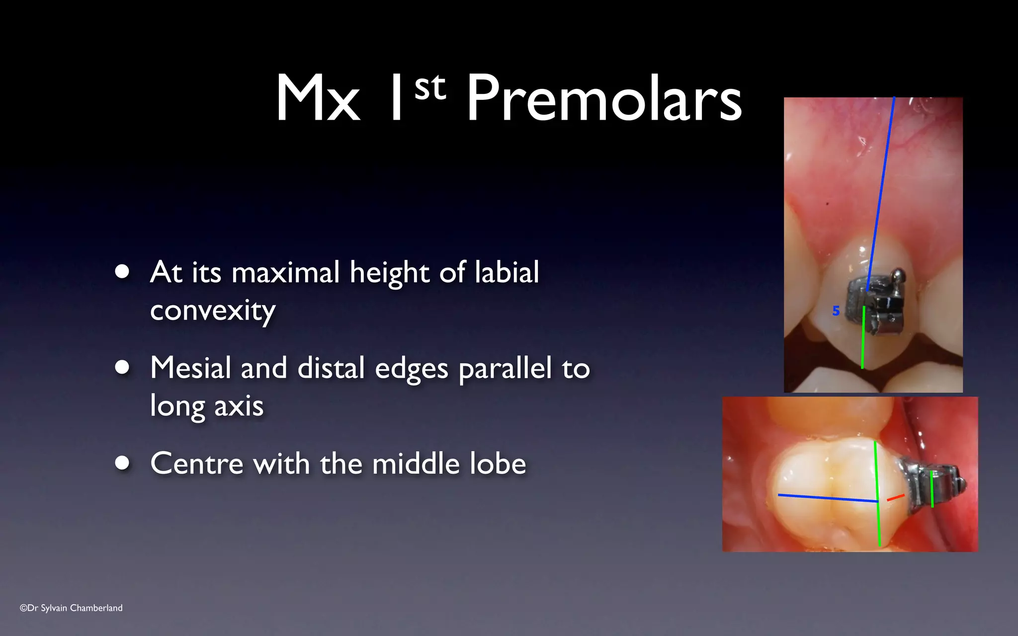 ©Dr Sylvain Chamberland
Mx 1st Premolars
• At its maximal height of labial
convexity
• Mesial and distal edges parallel to
long axis
• Centre with the middle lobe
5
 