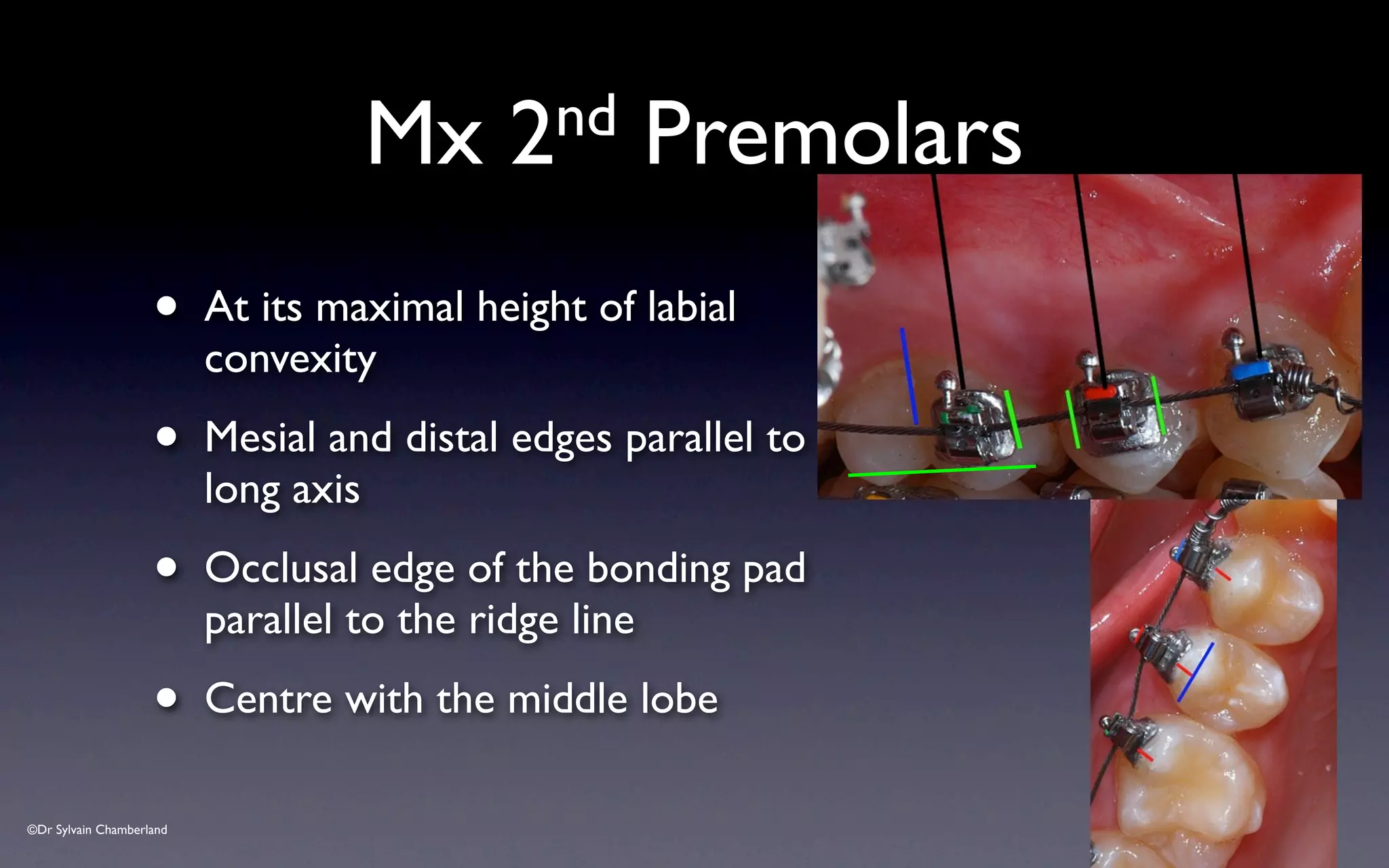 ©Dr Sylvain Chamberland
Mx 2nd Premolars
• At its maximal height of labial
convexity
• Mesial and distal edges parallel to
long axis
• Occlusal edge of the bonding pad
parallel to the ridge line
• Centre with the middle lobe
 
