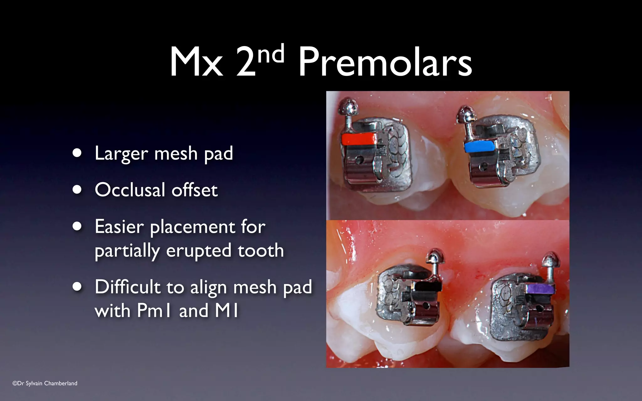 ©Dr Sylvain Chamberland
Mx 2nd Premolars
• Larger mesh pad
• Occlusal offset
• Easier placement for
partially erupted tooth
• Difficult to align mesh pad
with Pm1 and M1
 