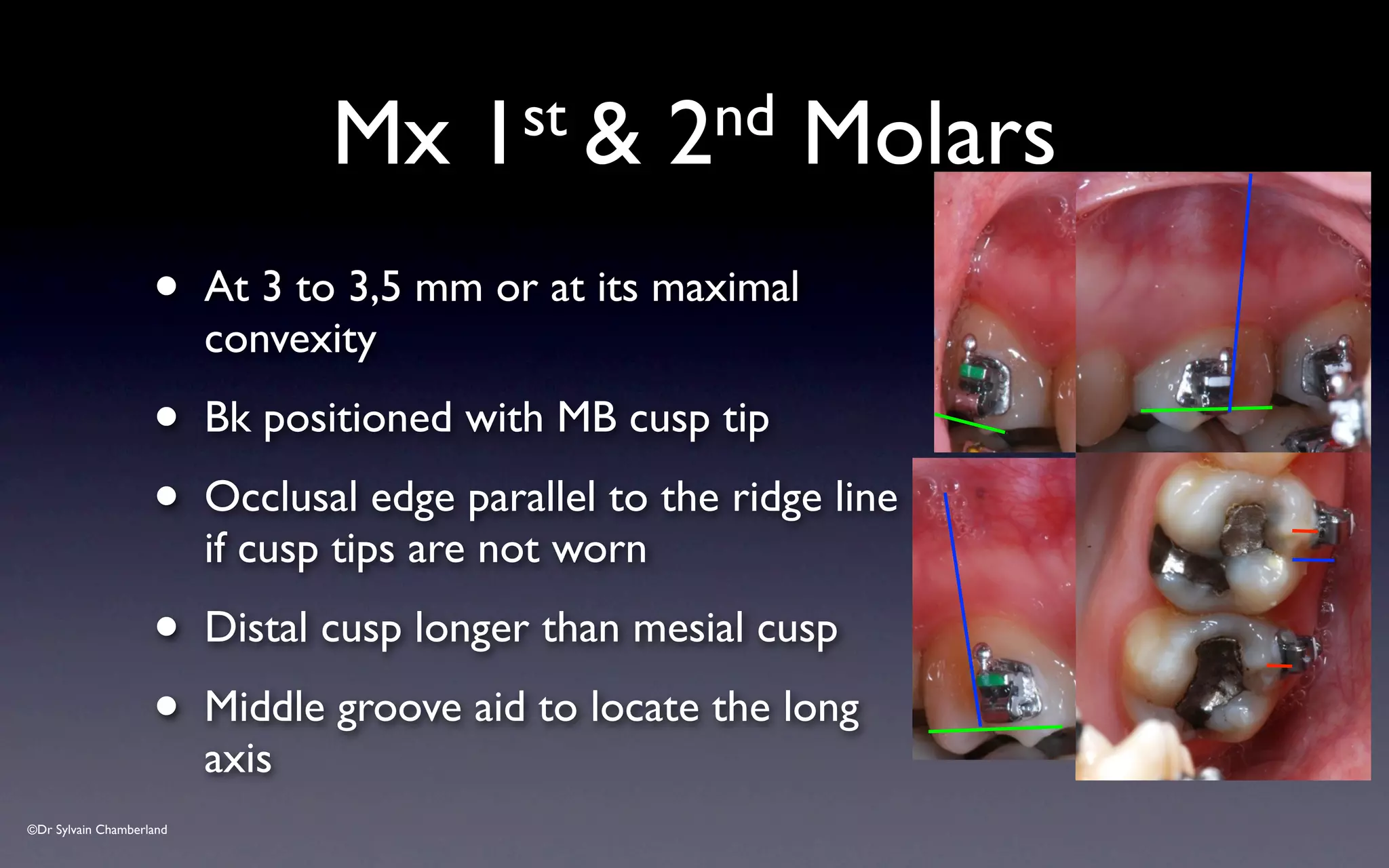 ©Dr Sylvain Chamberland
Mx 1st & 2nd Molars
• At 3 to 3,5 mm or at its maximal
convexity
• Bk positioned with MB cusp tip
• Occlusal edge parallel to the ridge line
if cusp tips are not worn
• Distal cusp longer than mesial cusp
• Middle groove aid to locate the long
axis
 