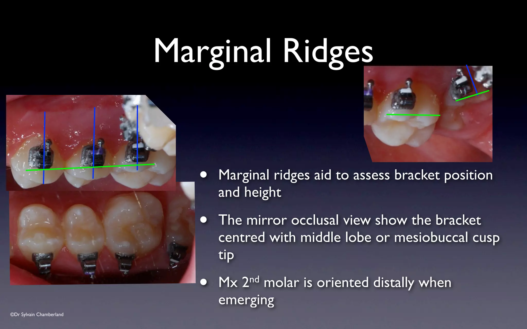 ©Dr Sylvain Chamberland
• Marginal ridges aid to assess bracket position
and height
• The mirror occlusal view show the bracket
centred with middle lobe or mesiobuccal cusp
tip
• Mx 2nd molar is oriented distally when
emerging
Marginal Ridges
 