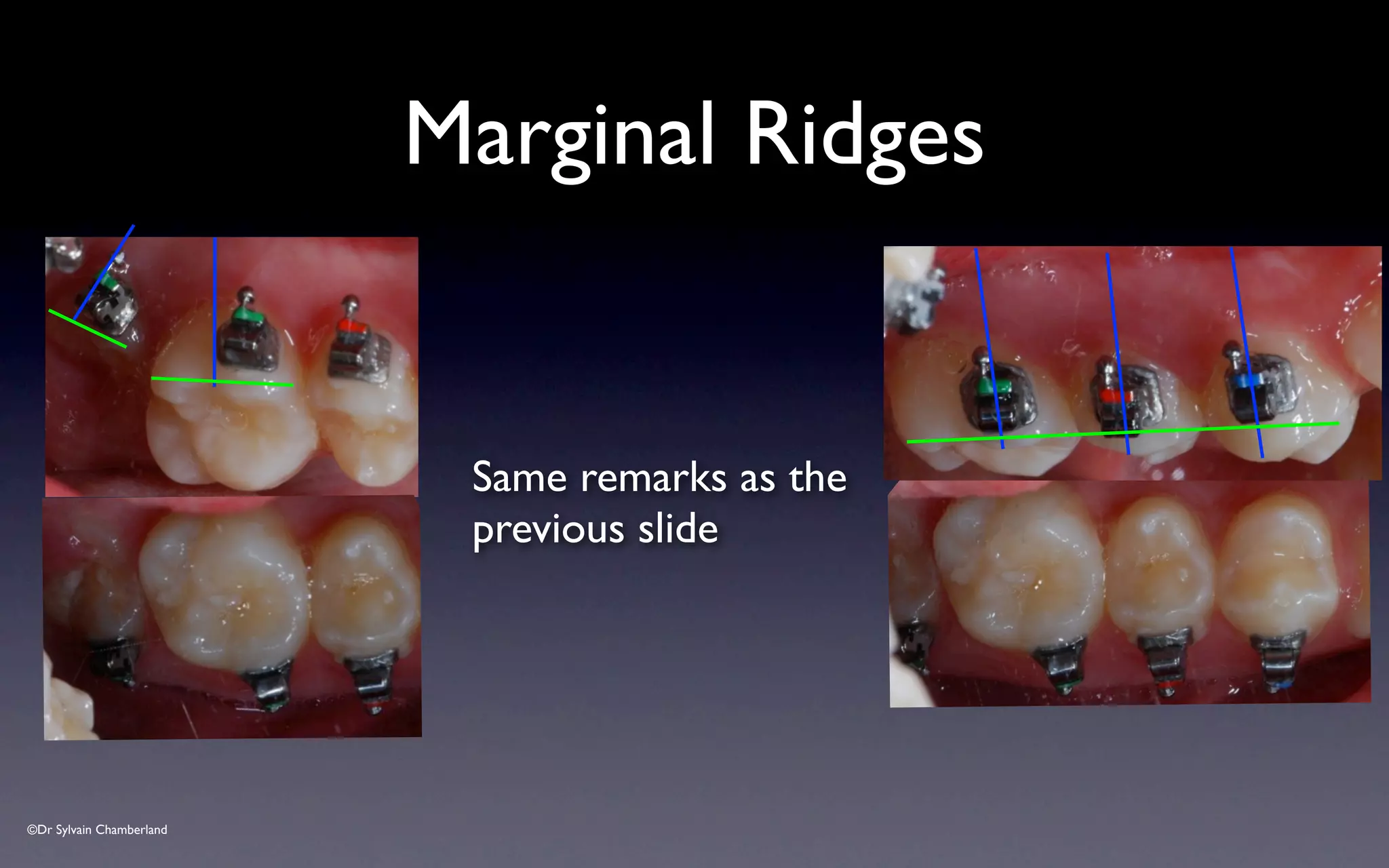 ©Dr Sylvain Chamberland
Marginal Ridges
Same remarks as the
previous slide
 