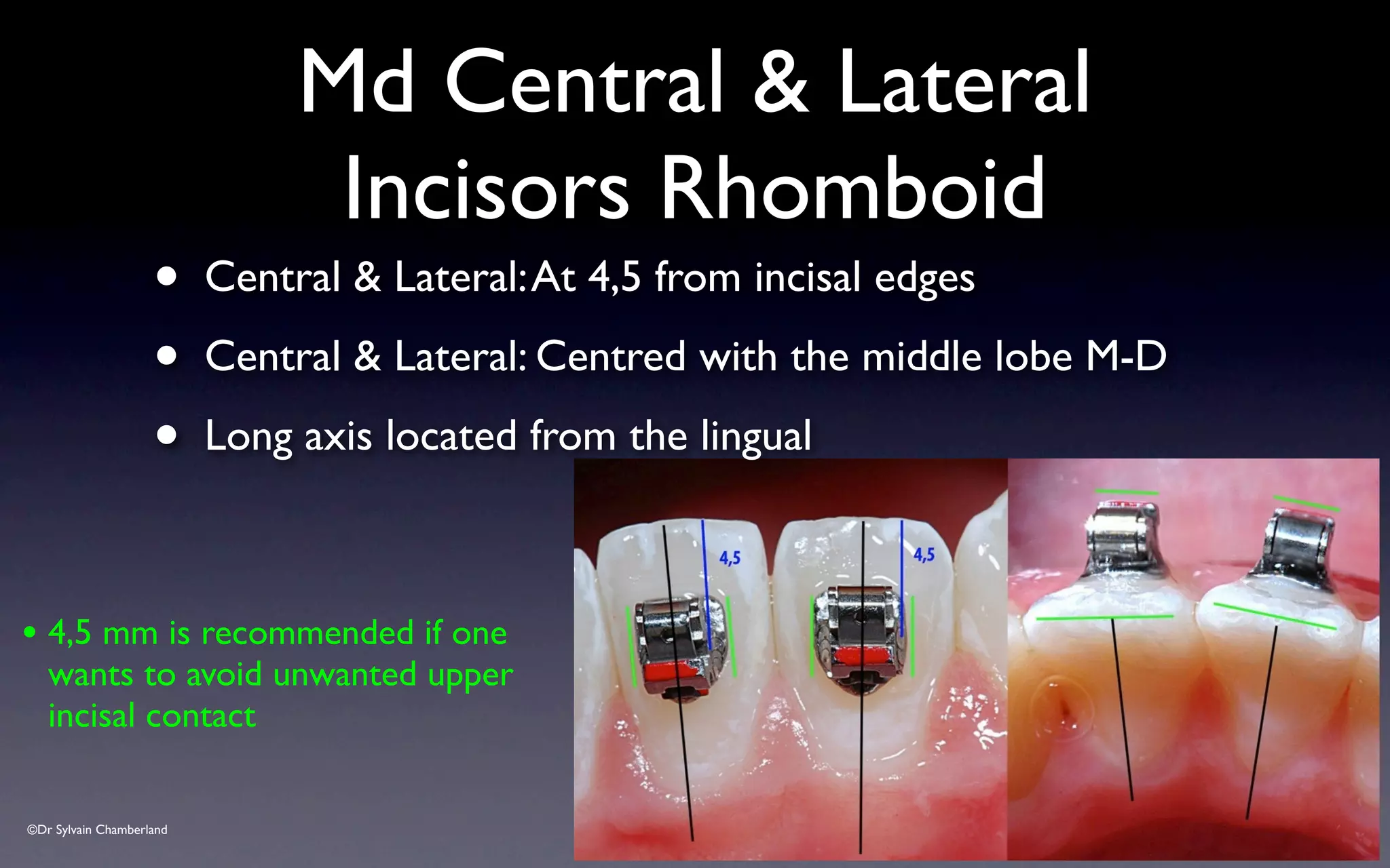 ©Dr Sylvain Chamberland
Md Central & Lateral
Incisors Rhomboid
• 4,5 mm is recommended if one
wants to avoid unwanted upper
incisal contact
• Central & Lateral:At 4,5 from incisal edges
• Central & Lateral: Centred with the middle lobe M-D
• Long axis located from the lingual
 
