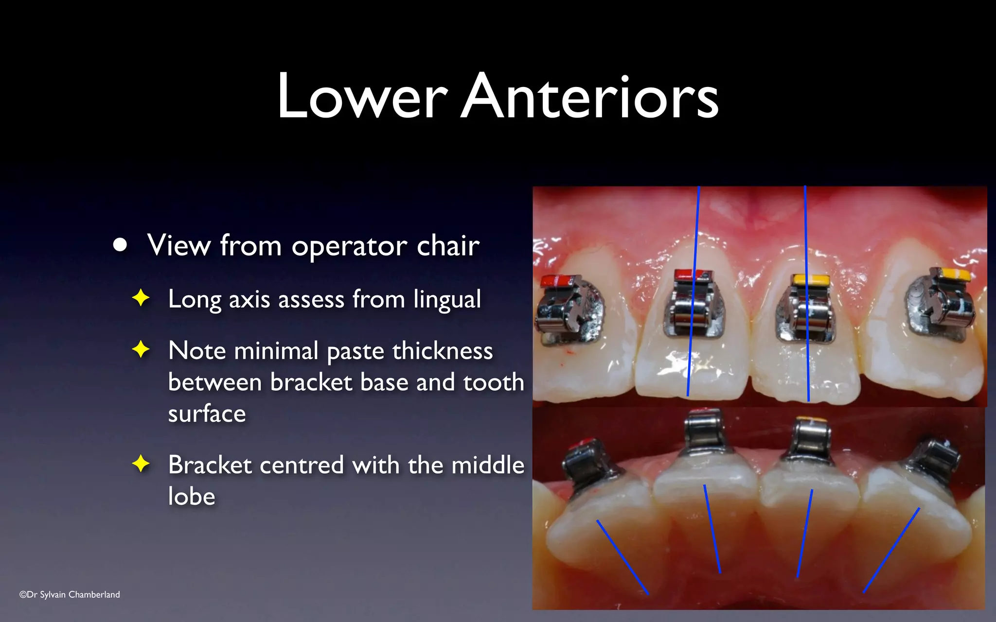 ©Dr Sylvain Chamberland
Lower Anteriors
• View from operator chair
✦ Long axis assess from lingual
✦ Note minimal paste thickness
between bracket base and tooth
surface
✦ Bracket centred with the middle
lobe
 