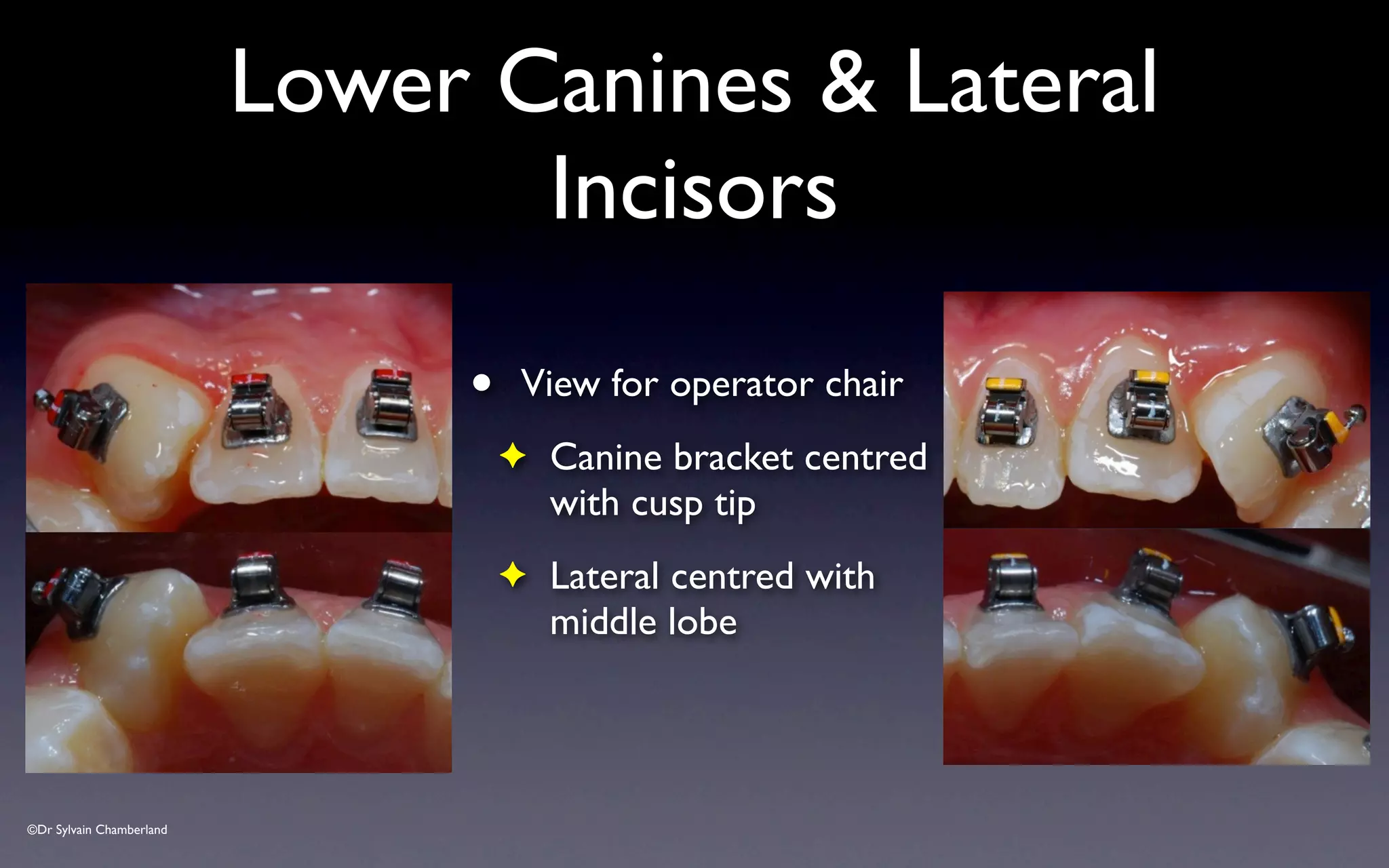 ©Dr Sylvain Chamberland
Lower Canines & Lateral
Incisors
• View for operator chair
✦ Canine bracket centred
with cusp tip
✦ Lateral centred with
middle lobe
 