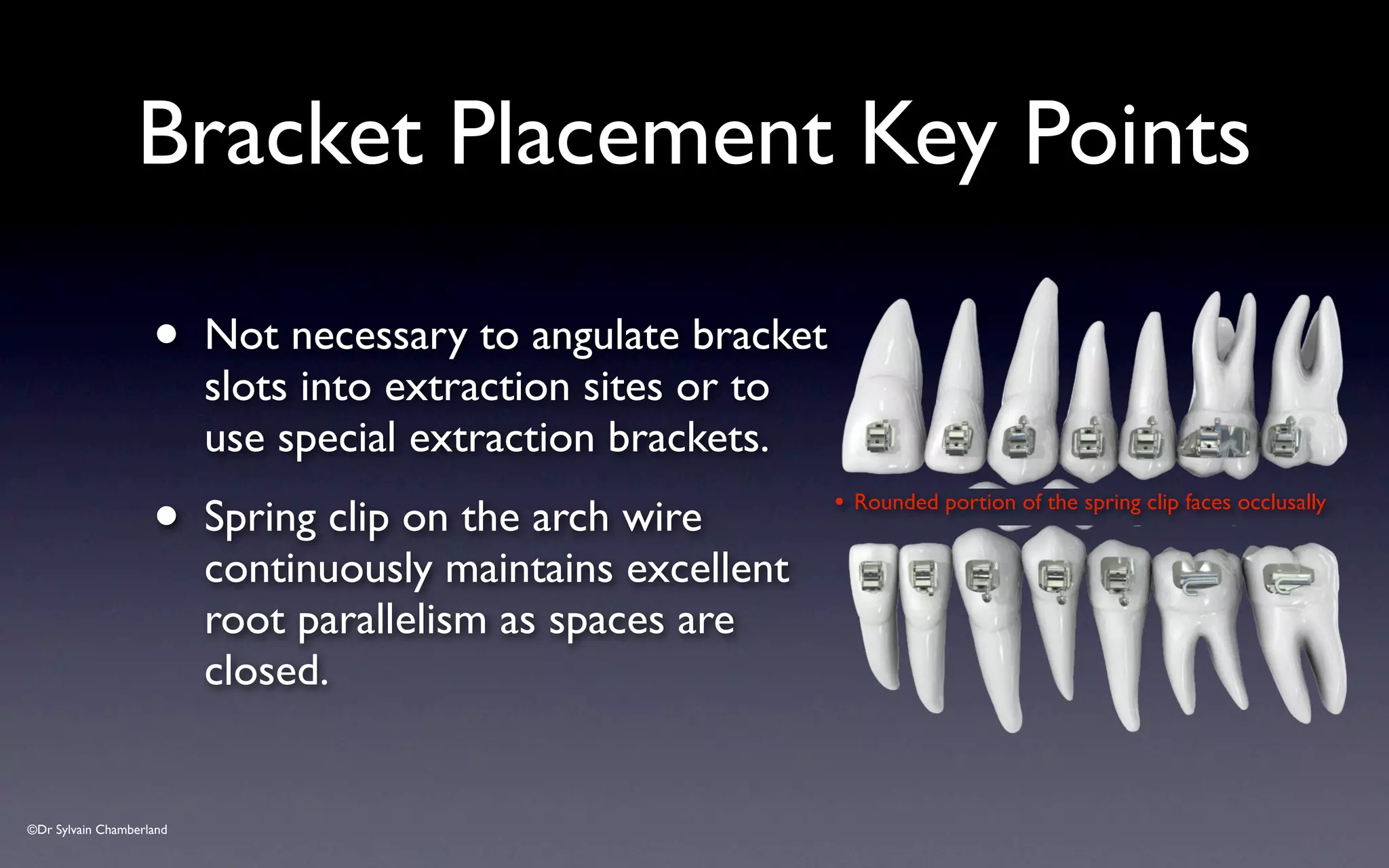 ©Dr Sylvain Chamberland
Bracket Placement Key Points
• Not necessary to angulate bracket
slots into extraction sites or to
use special extraction brackets.
• Spring clip on the arch wire
continuously maintains excellent
root parallelism as spaces are
closed.
• Rounded portion of the spring clip faces occlusally
 