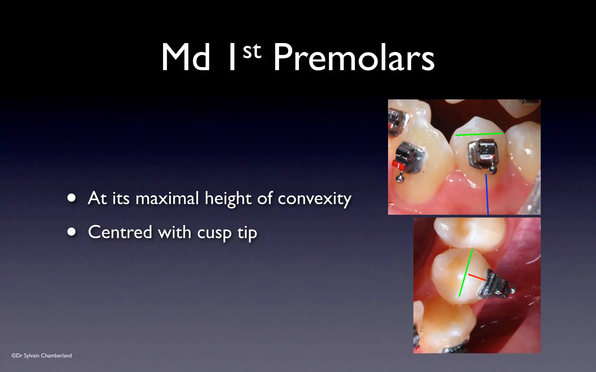 ©Dr Sylvain Chamberland
Md 1st Premolars
• At its maximal height of convexity
• Centred with cusp tip
 