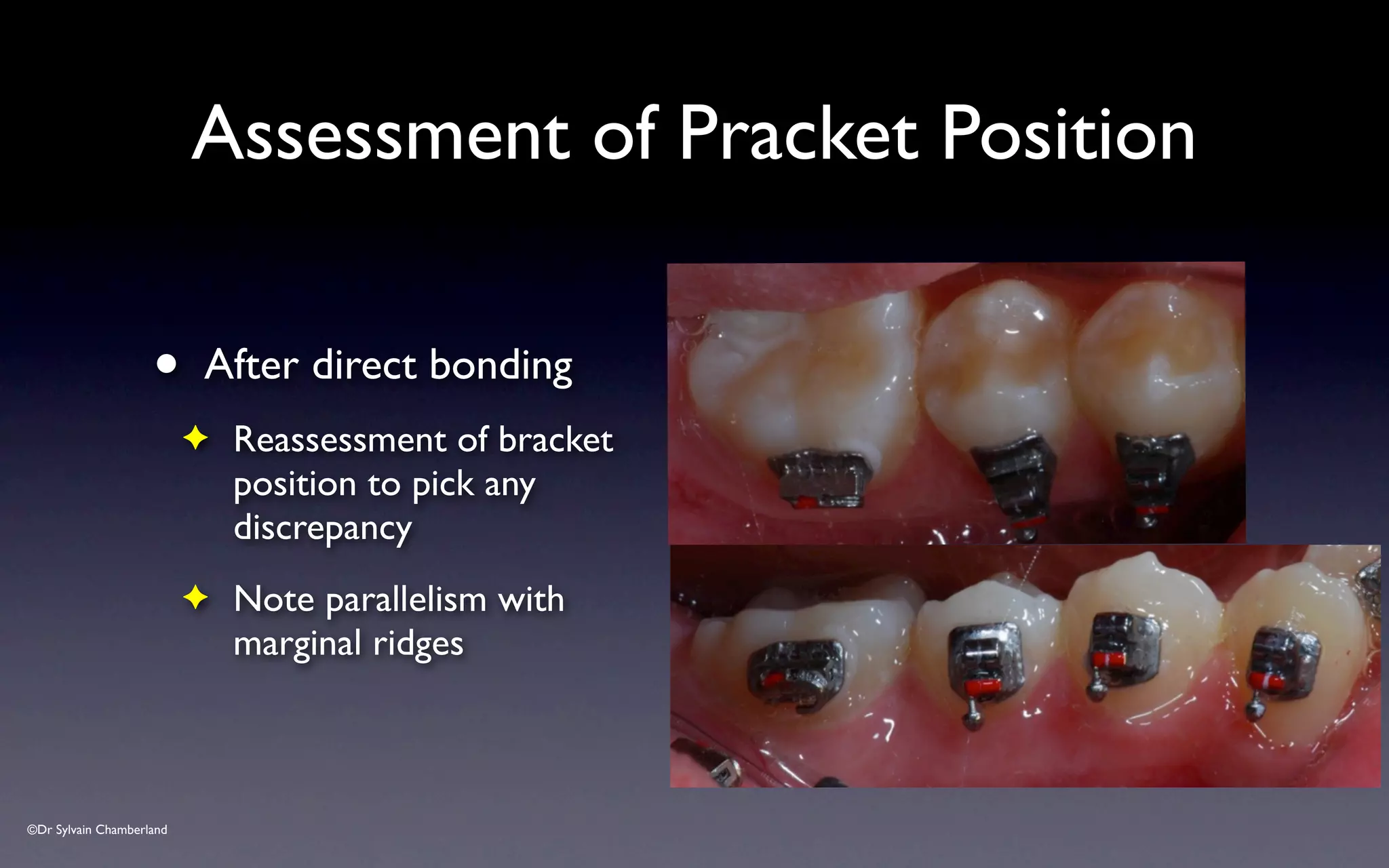 ©Dr Sylvain Chamberland
Assessment of Pracket Position
• After direct bonding
✦ Reassessment of bracket
position to pick any
discrepancy
✦ Note parallelism with
marginal ridges
 