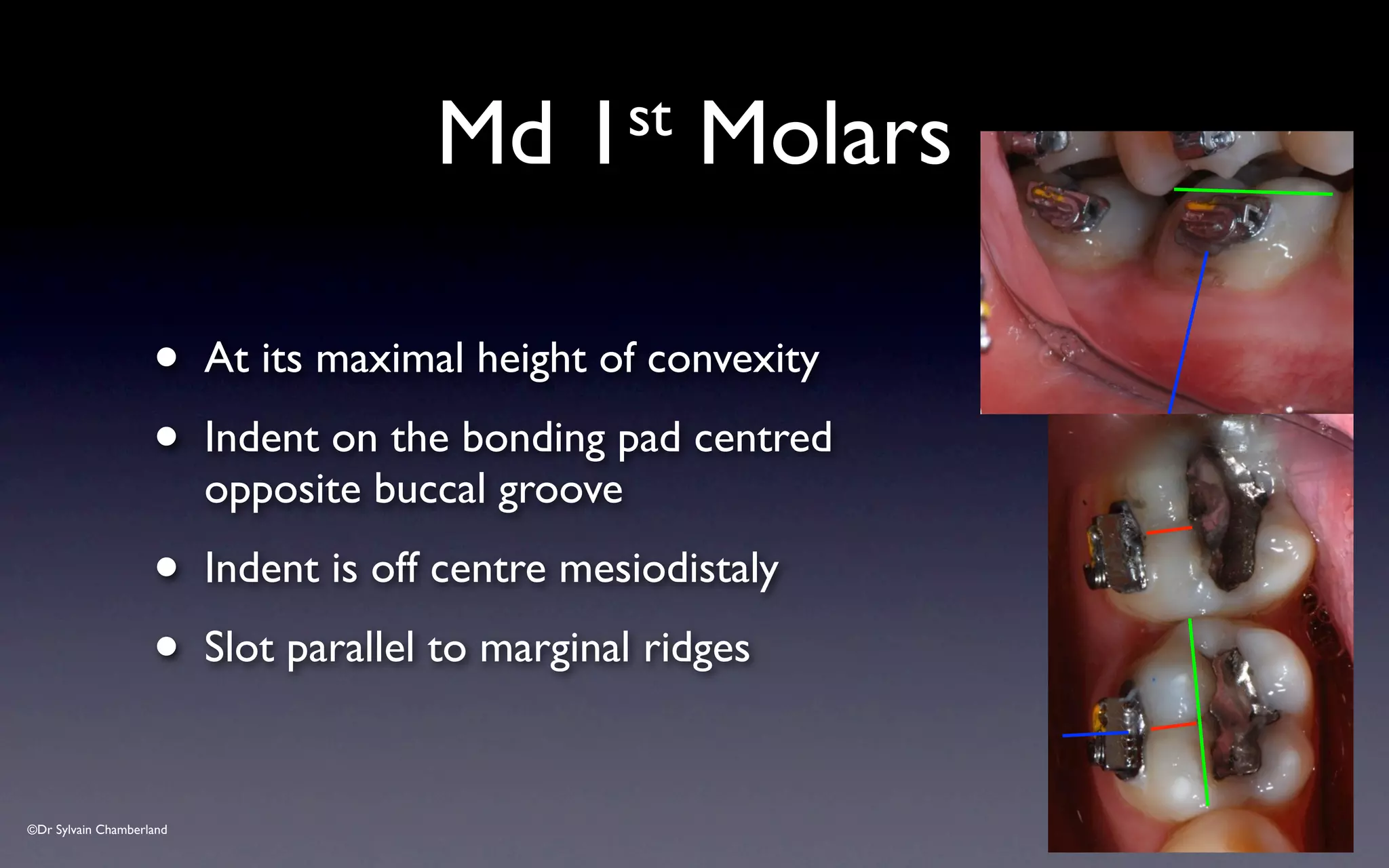 ©Dr Sylvain Chamberland
Md 1st Molars
• At its maximal height of convexity
• Indent on the bonding pad centred
opposite buccal groove
• Indent is off centre mesiodistaly
• Slot parallel to marginal ridges
 