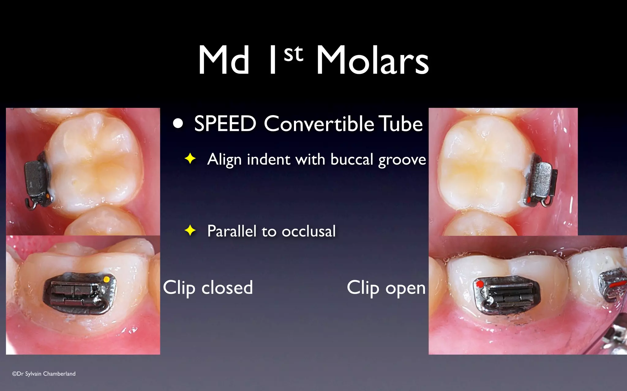 ©Dr Sylvain Chamberland
Md 1st Molars
• SPEED Convertible Tube
✦ Align indent with buccal groove
✦ Parallel to occlusal
Clip closed Clip open
 