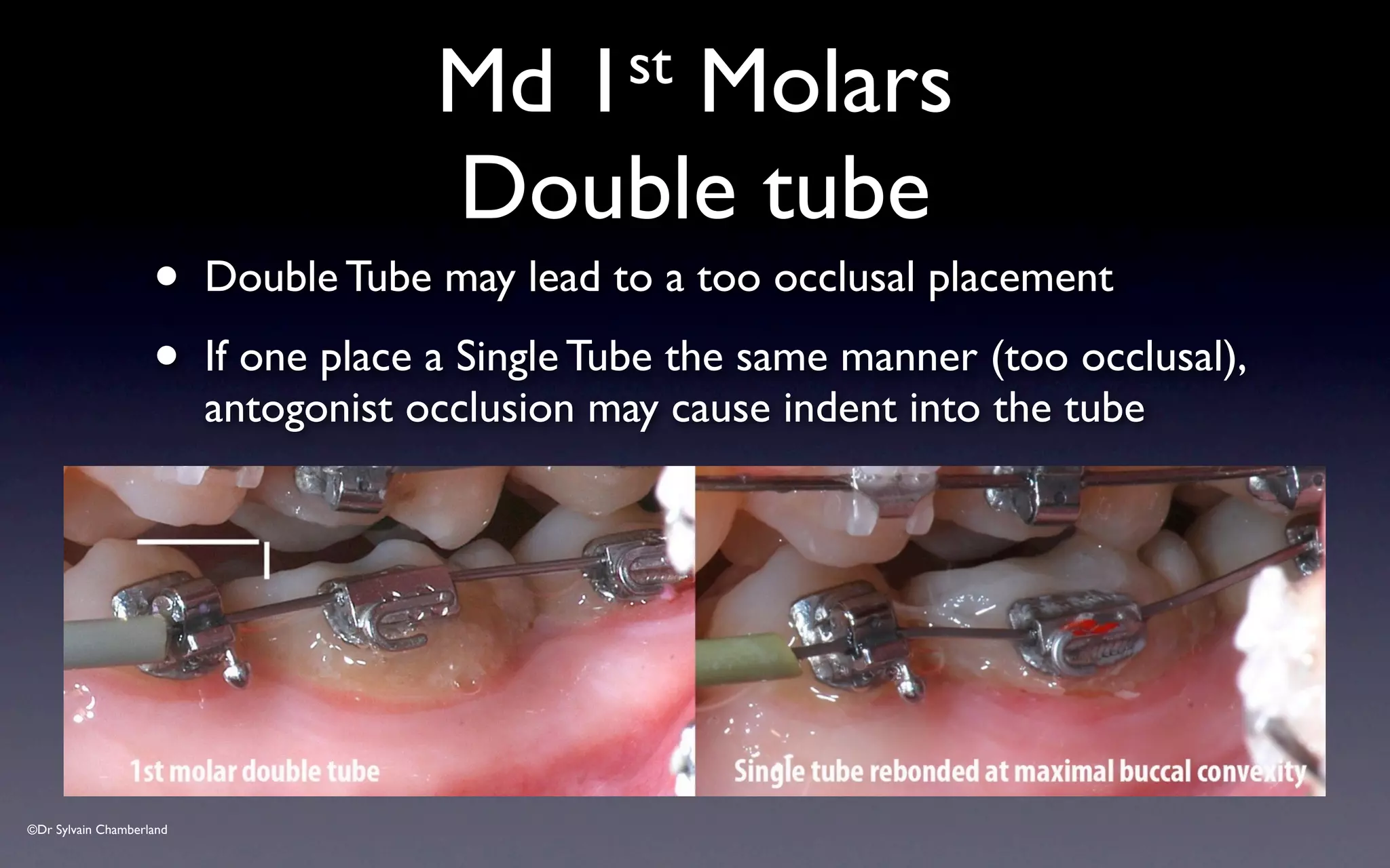 ©Dr Sylvain Chamberland
Md 1st Molars
Double tube
• Double Tube may lead to a too occlusal placement
• If one place a Single Tube the same manner (too occlusal),
antogonist occlusion may cause indent into the tube
 