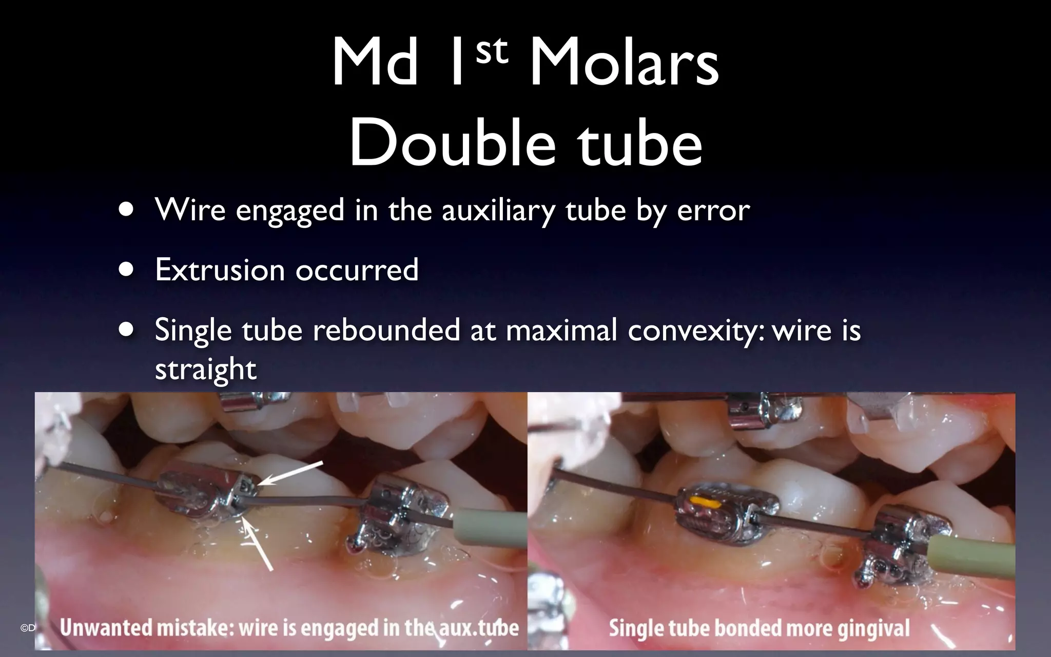 ©Dr Sylvain Chamberland
Md 1st Molars
Double tube
• Wire engaged in the auxiliary tube by error
• Extrusion occurred
• Single tube rebounded at maximal convexity: wire is
straight
 