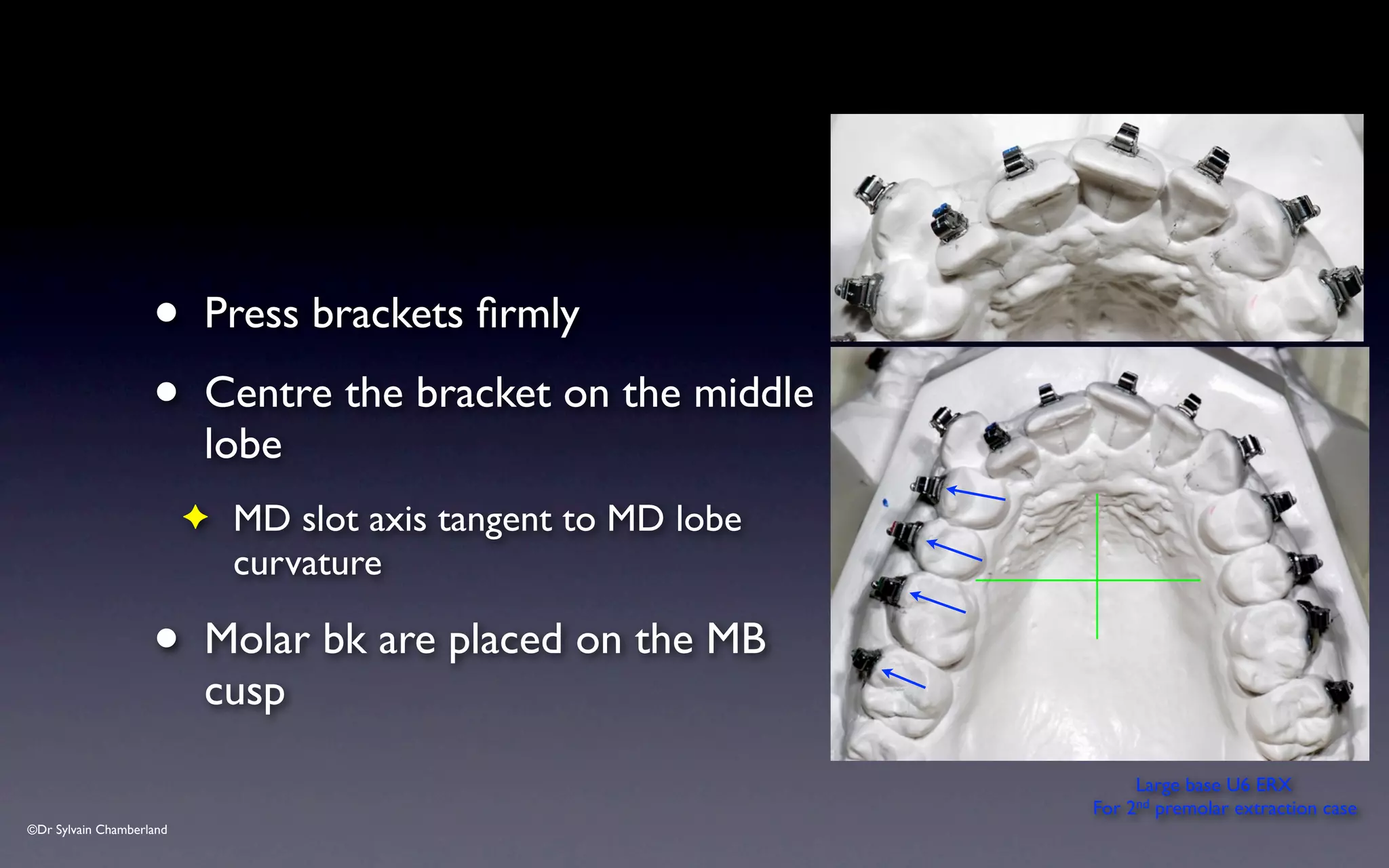 ©Dr Sylvain Chamberland
• Press brackets firmly
• Centre the bracket on the middle
lobe
✦ MD slot axis tangent to MD lobe
curvature
• Molar bk are placed on the MB
cusp
Large base U6 ERX
For 2nd premolar extraction case
 