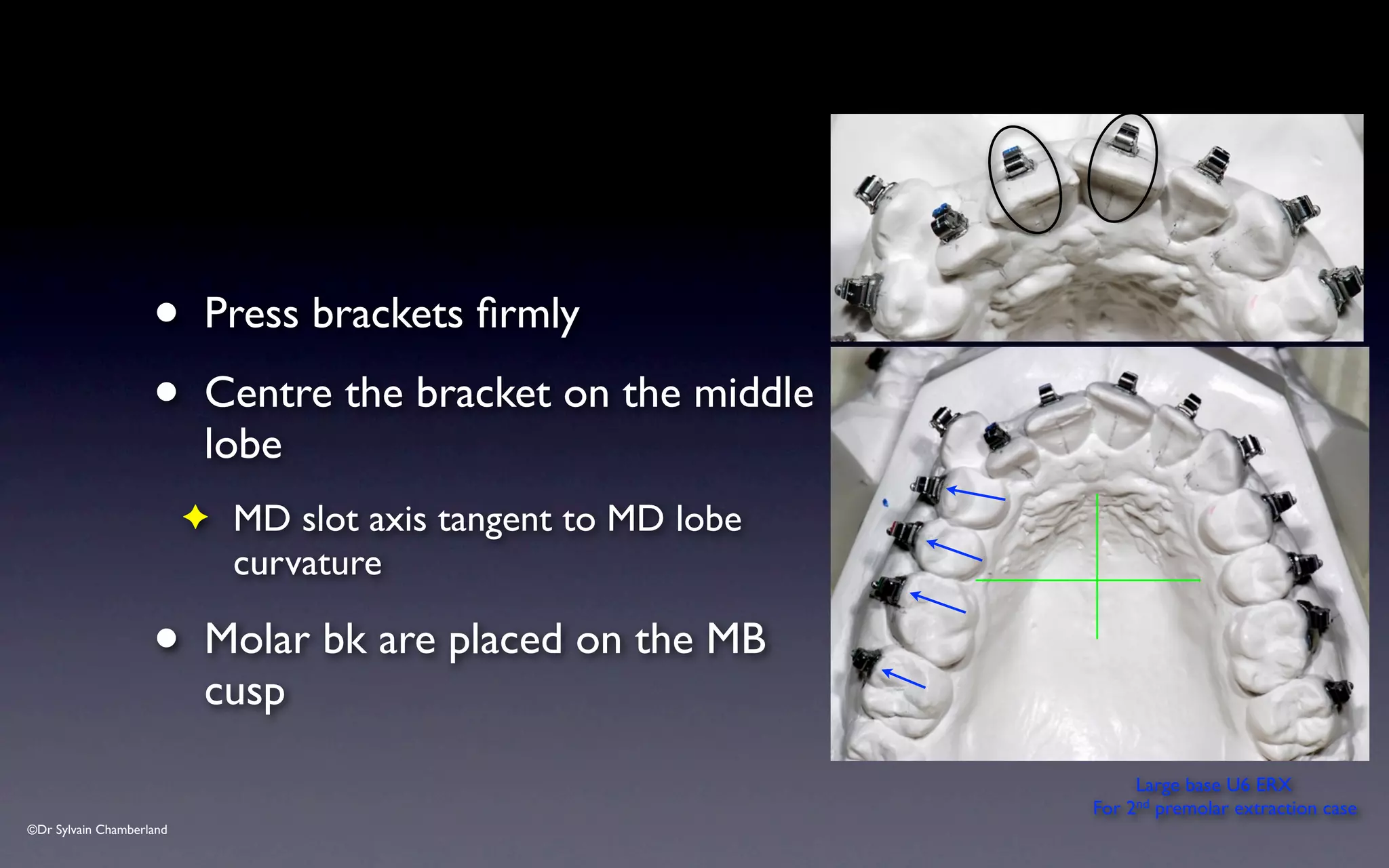 ©Dr Sylvain Chamberland
• Press brackets firmly
• Centre the bracket on the middle
lobe
✦ MD slot axis tangent to MD lobe
curvature
• Molar bk are placed on the MB
cusp
Large base U6 ERX
For 2nd premolar extraction case
 