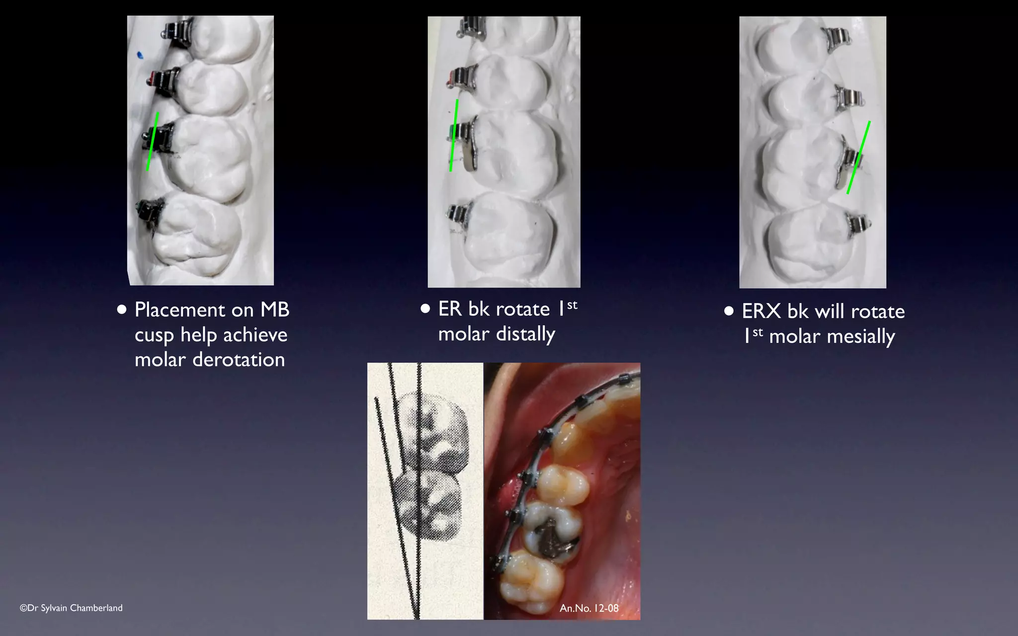 ©Dr Sylvain Chamberland An.No. 12-08
• ERX bk will rotate
1st molar mesially
• Placement on MB
cusp help achieve
molar derotation
• ER bk rotate 1st
molar distally
 