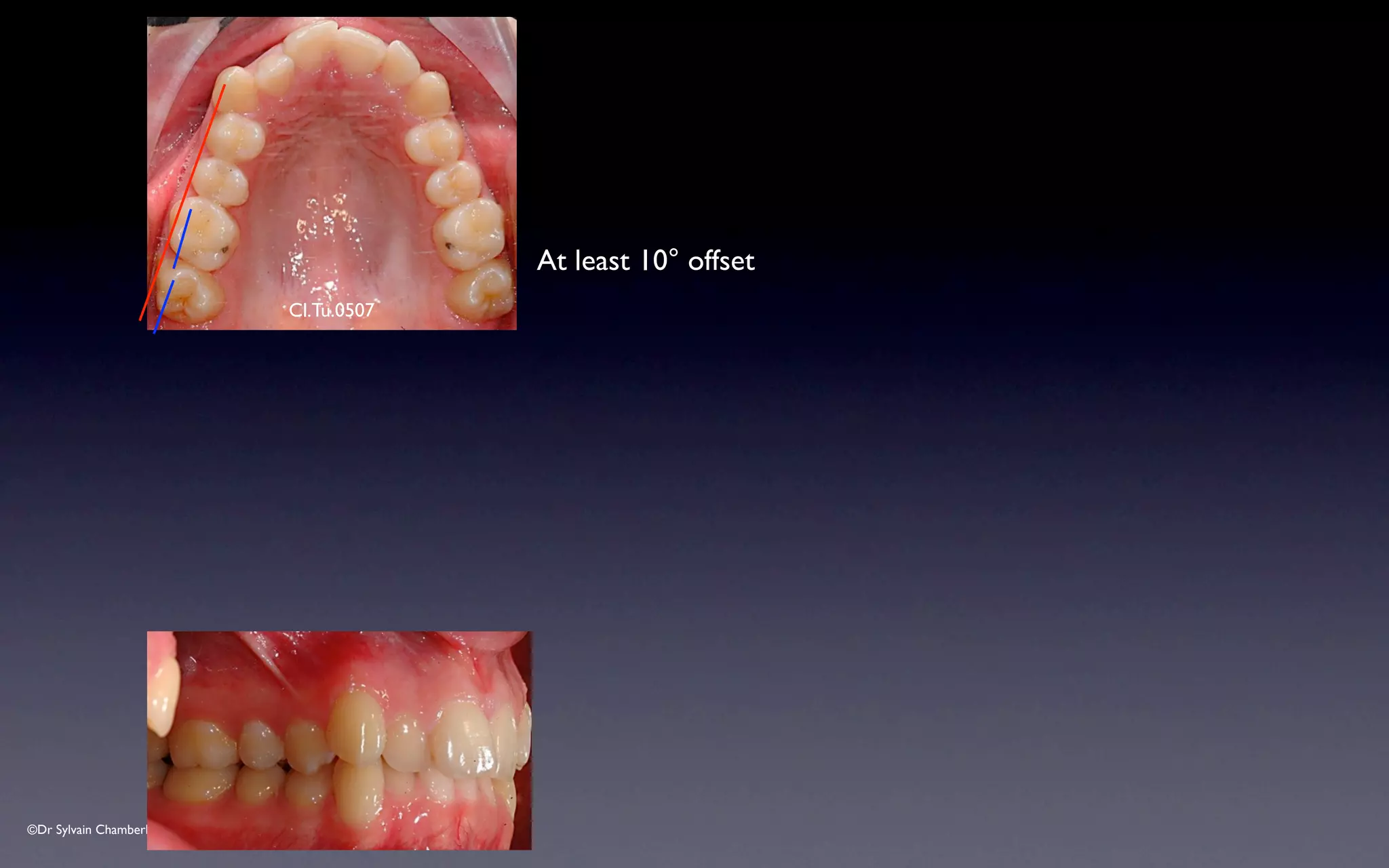 ©Dr Sylvain Chamberland
Cl.Tu.0507
At least 10° offset
 