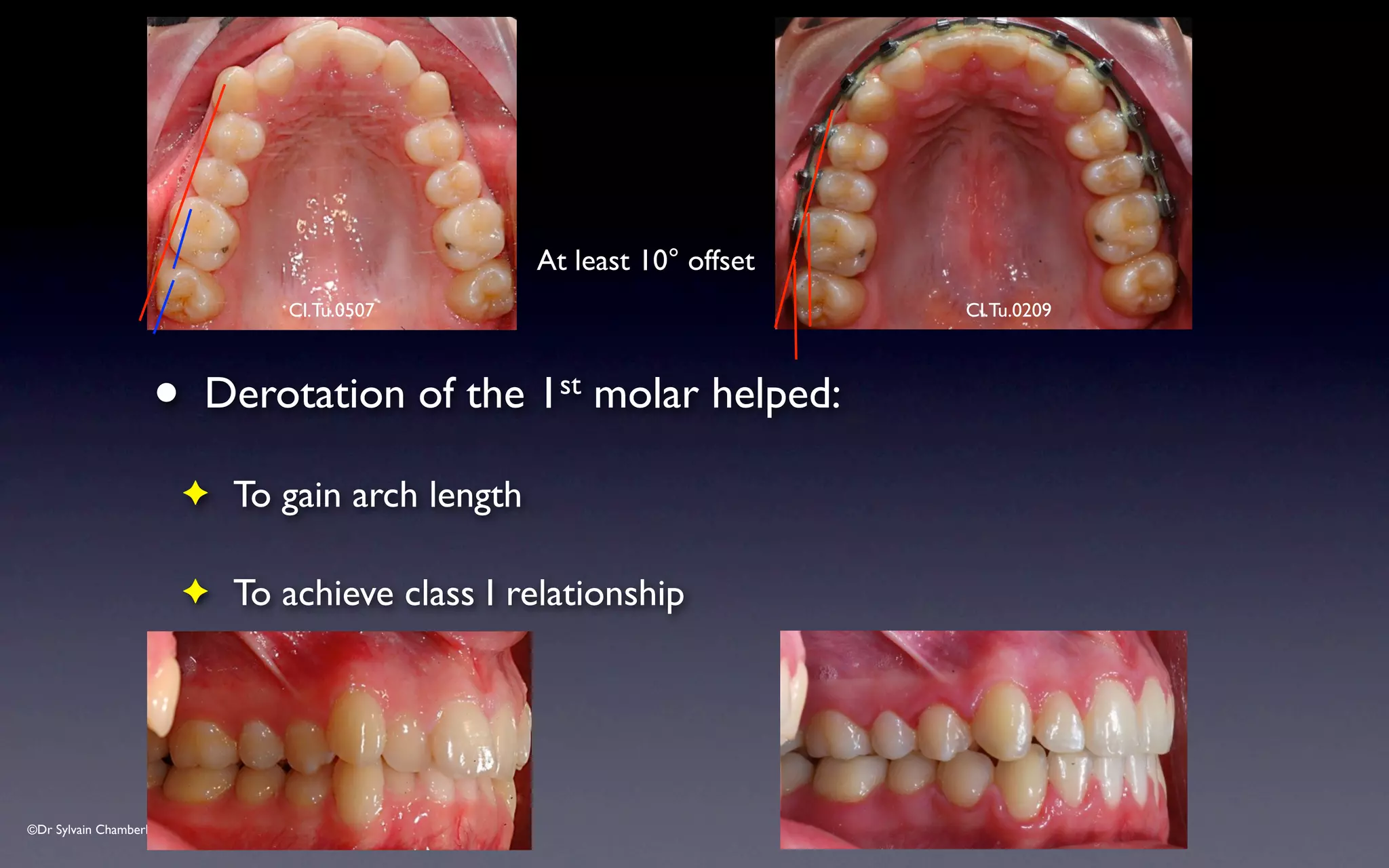 ©Dr Sylvain Chamberland
• Derotation of the 1st molar helped:
✦ To gain arch length
✦ To achieve class I relationship
Cl.Tu.0507 Cl.Tu.0209
At least 10° offset
 