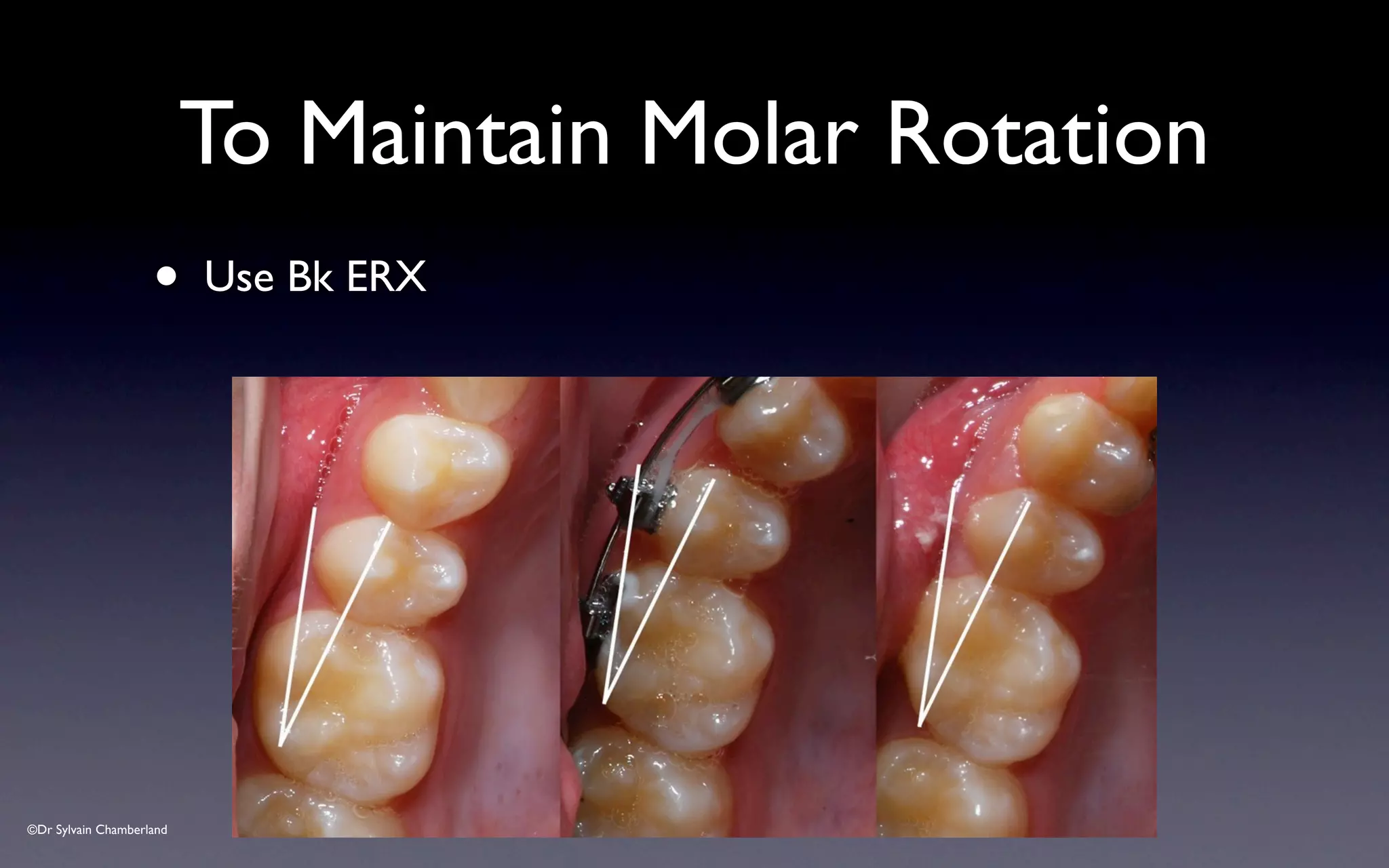 ©Dr Sylvain Chamberland
• Use Bk ERX
To Maintain Molar Rotation
 
