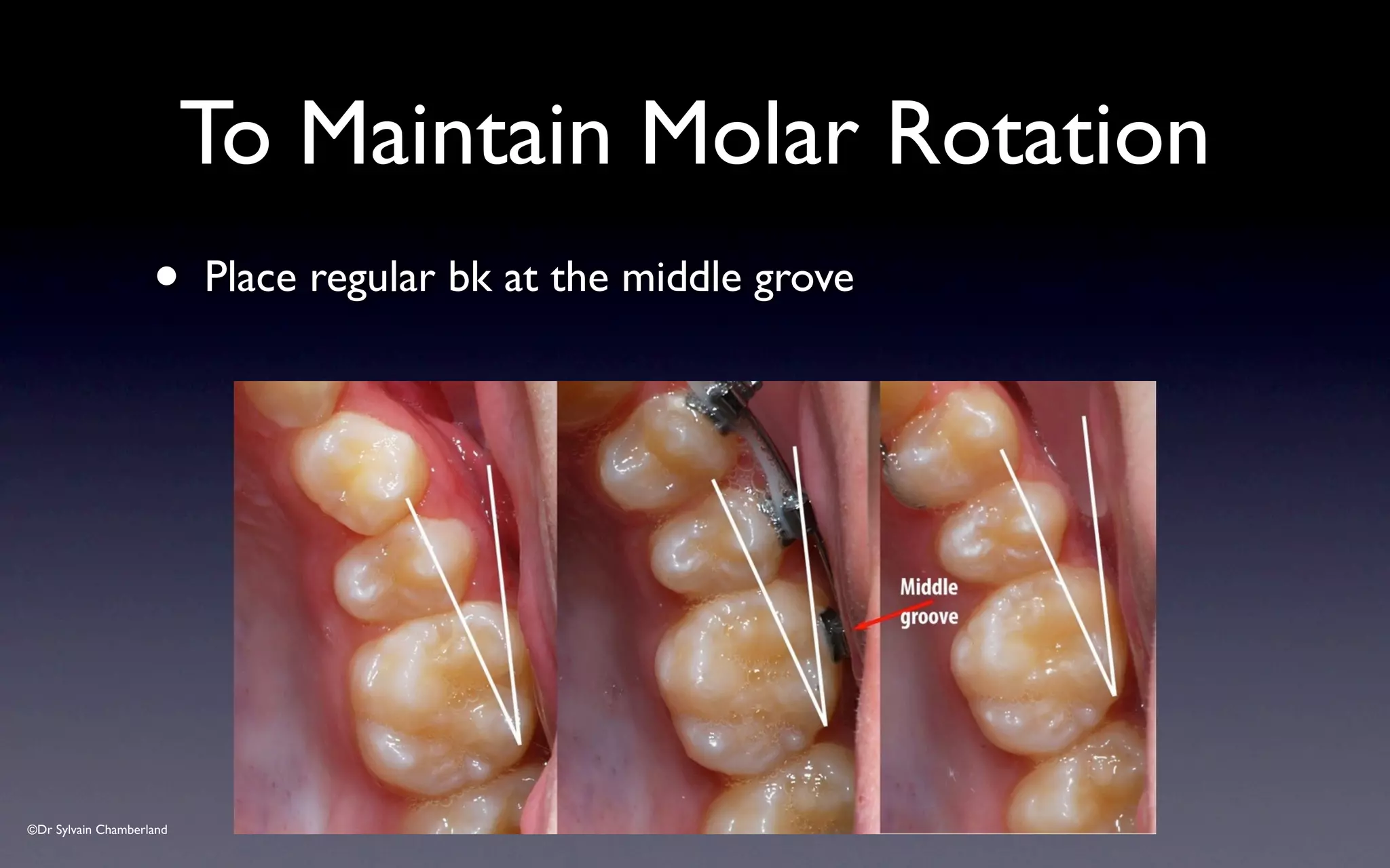 ©Dr Sylvain Chamberland
• Place regular bk at the middle grove
To Maintain Molar Rotation
 