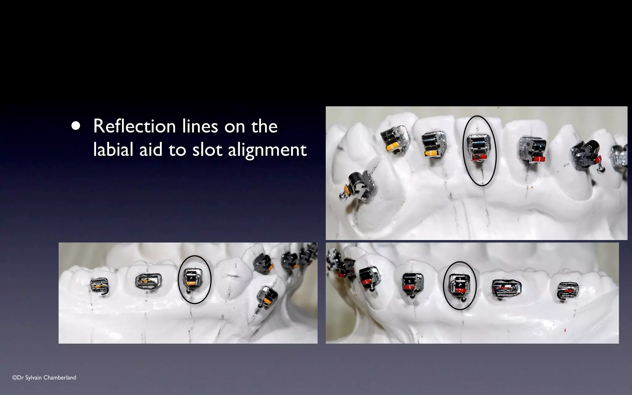 ©Dr Sylvain Chamberland
• Reflection lines on the
labial aid to slot alignment
 