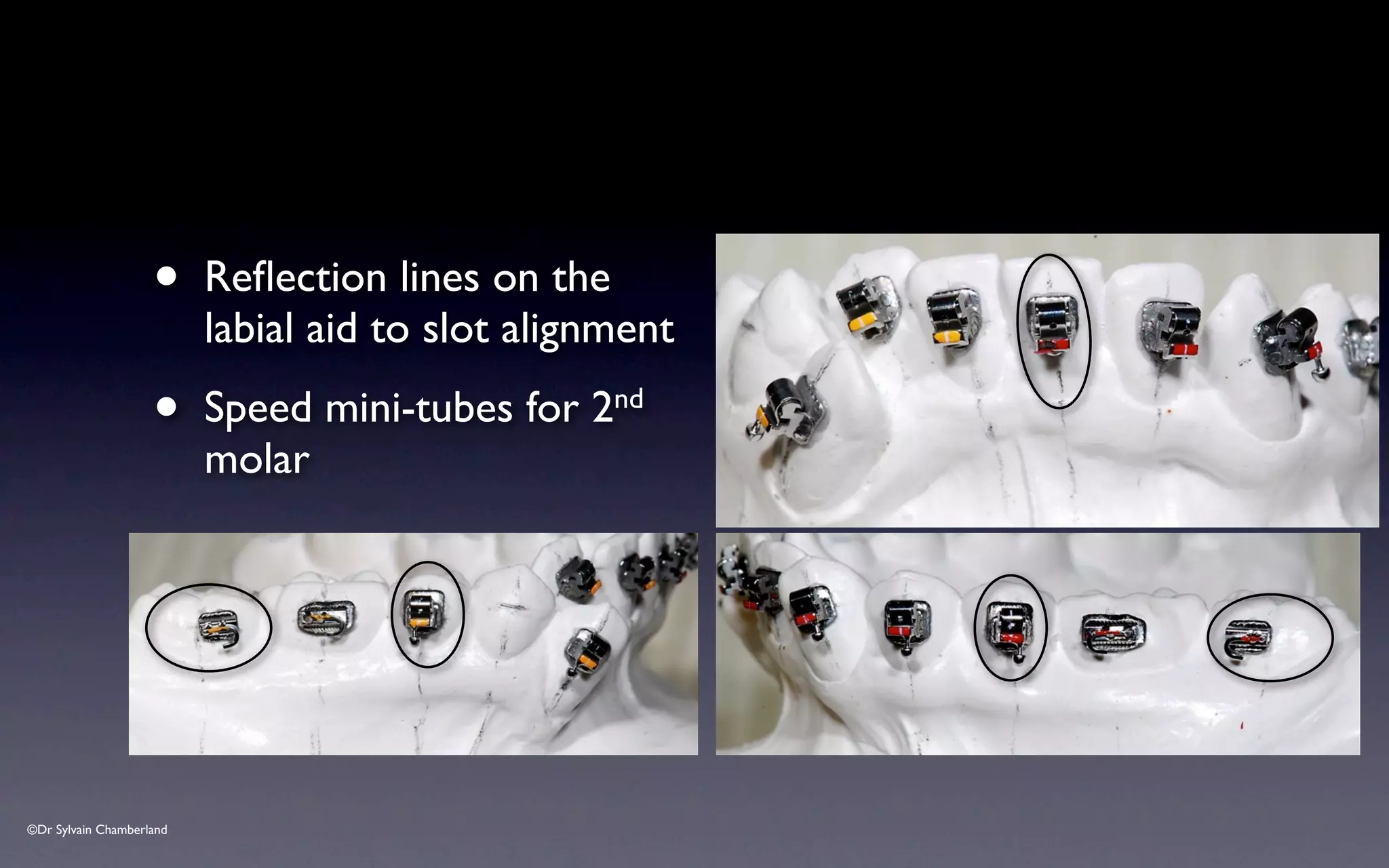 ©Dr Sylvain Chamberland
• Reflection lines on the
labial aid to slot alignment
• Speed mini-tubes for 2nd
molar
 