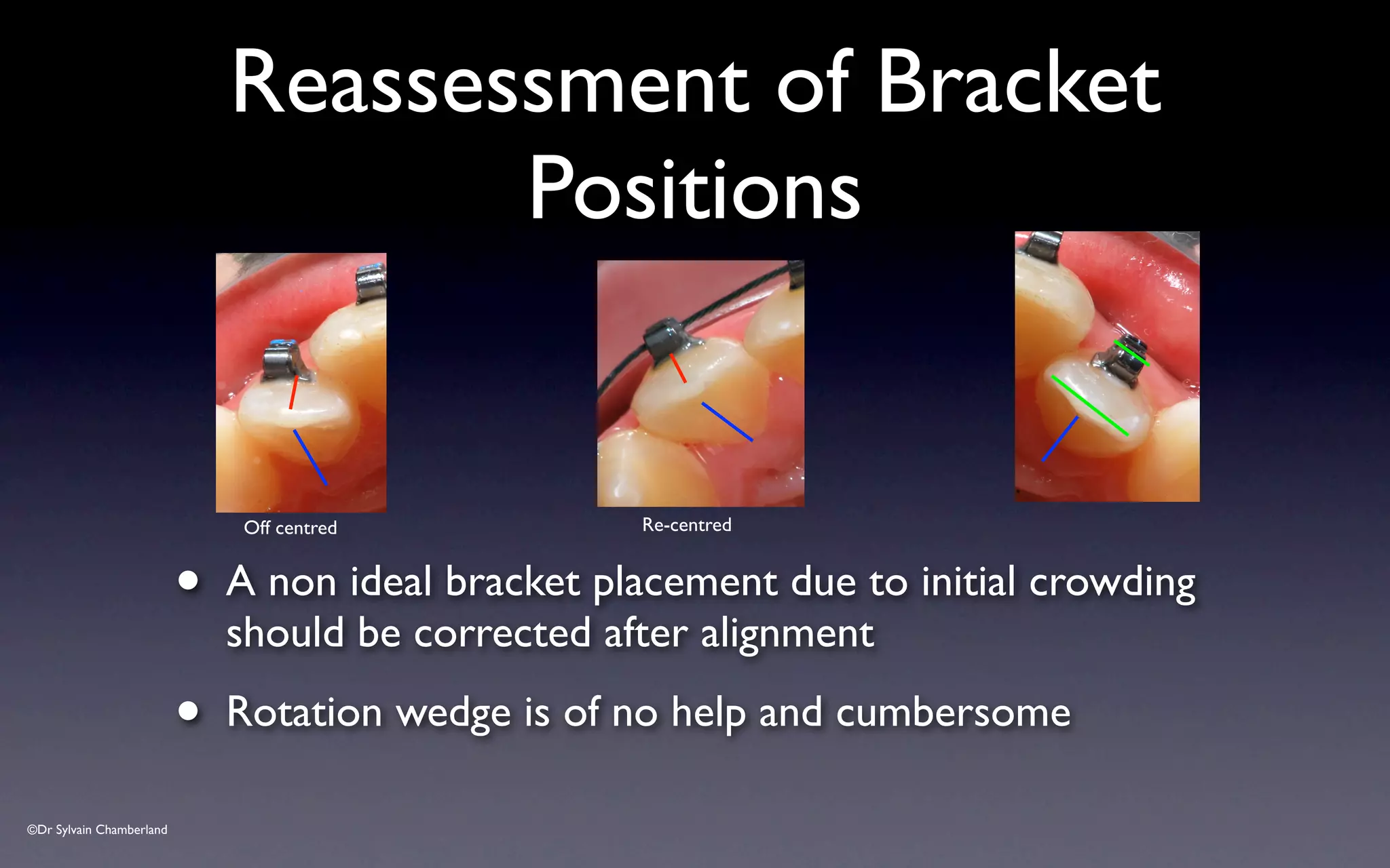 ©Dr Sylvain Chamberland
Reassessment of Bracket
Positions
• A non ideal bracket placement due to initial crowding
should be corrected after alignment
• Rotation wedge is of no help and cumbersome
Off centred Re-centred
 