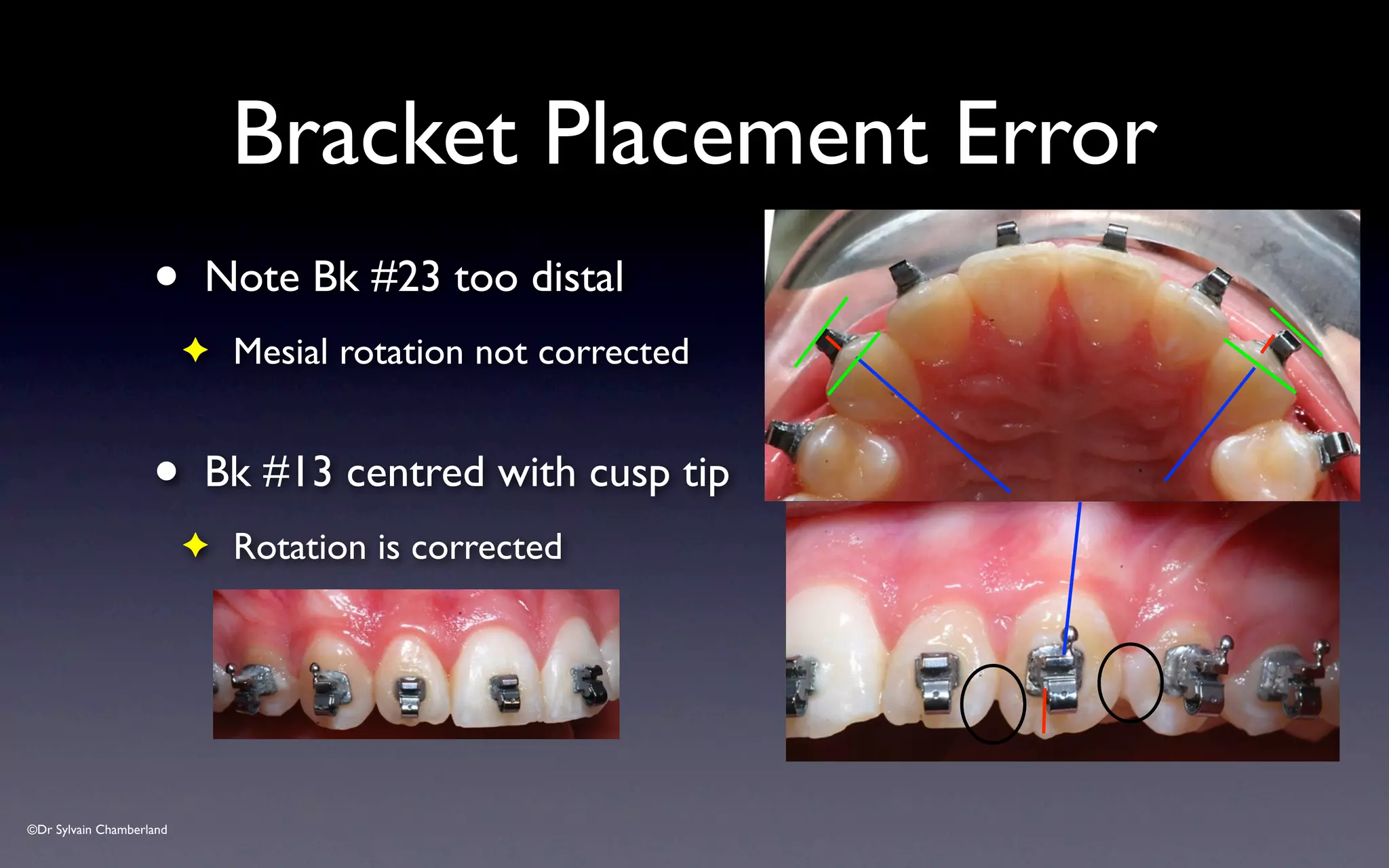 ©Dr Sylvain Chamberland
Bracket Placement Error
• Note Bk #23 too distal
✦ Mesial rotation not corrected
• Bk #13 centred with cusp tip
✦ Rotation is corrected
 