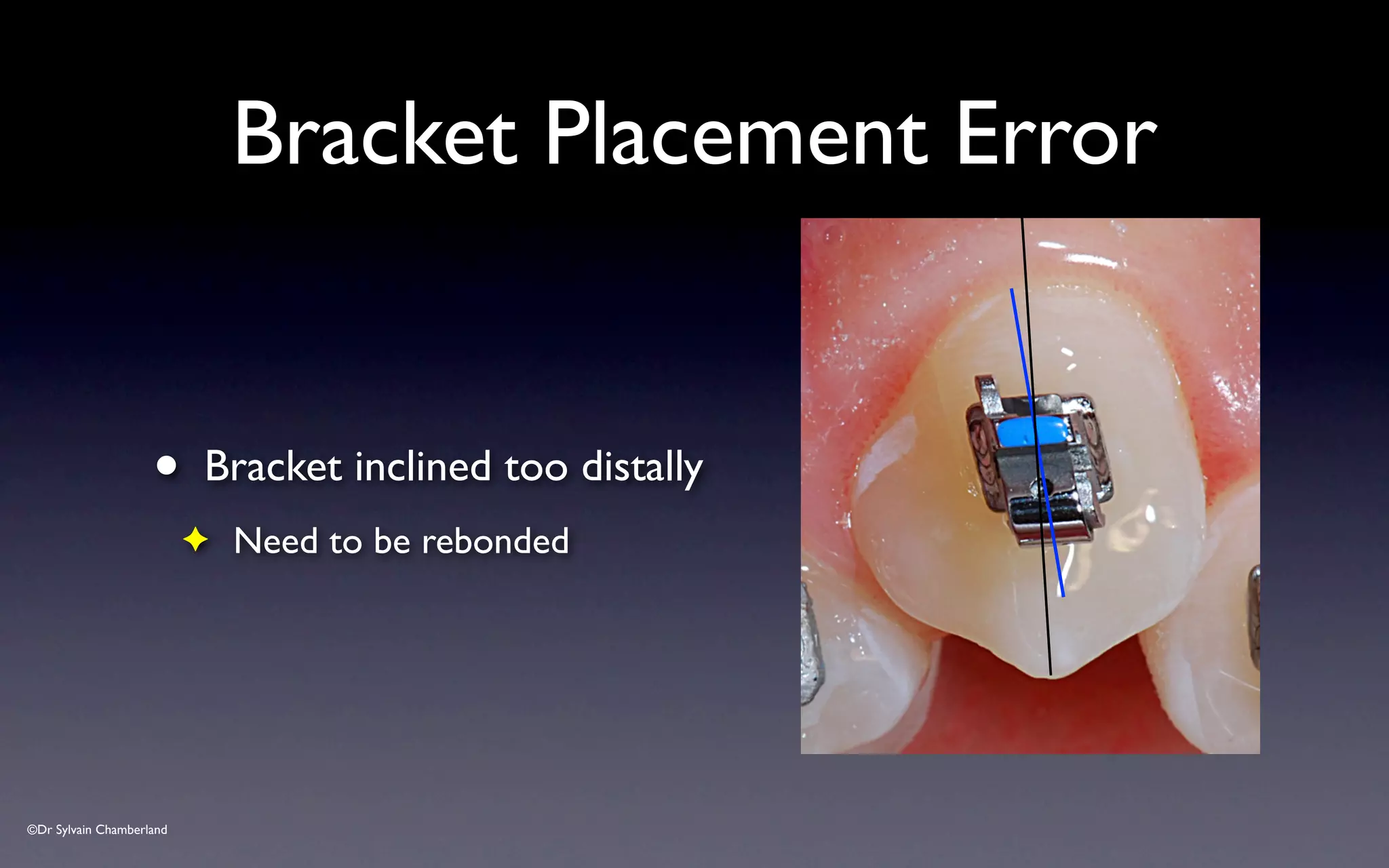 ©Dr Sylvain Chamberland
Bracket Placement Error
• Bracket inclined too distally
✦ Need to be rebonded
 