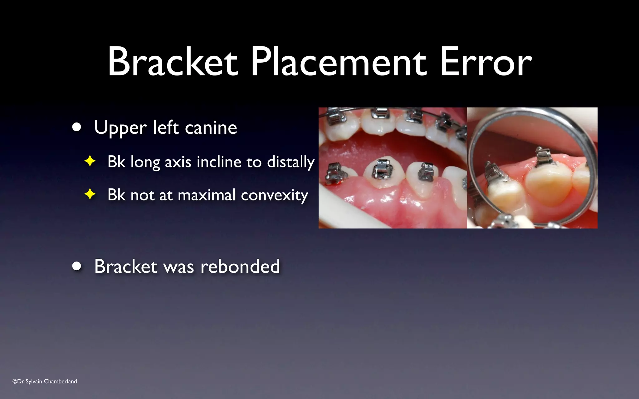 ©Dr Sylvain Chamberland
Bracket Placement Error
• Upper left canine
✦ Bk long axis incline to distally
✦ Bk not at maximal convexity
• Bracket was rebonded
 