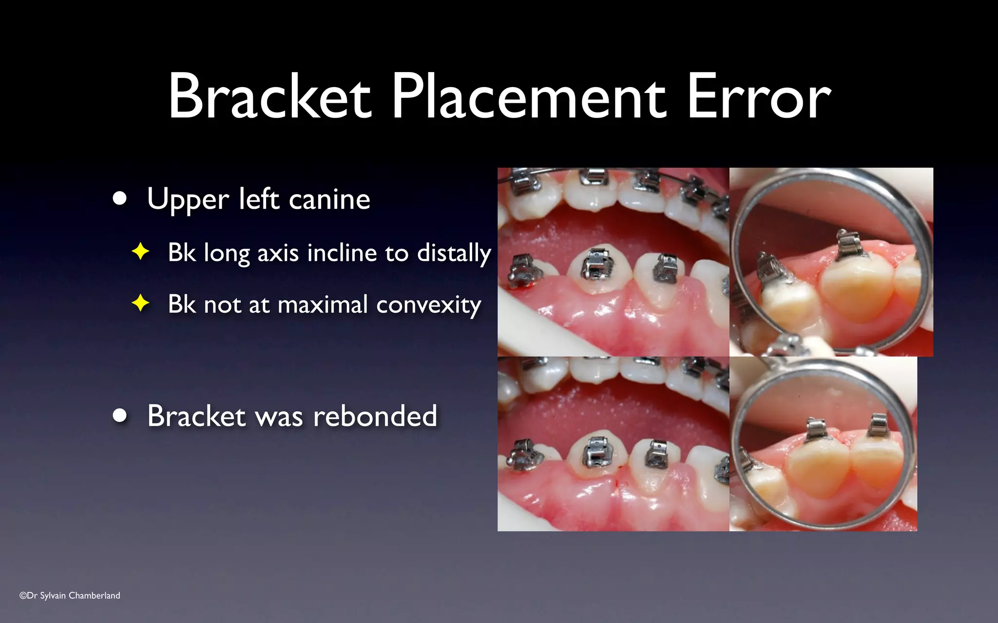 ©Dr Sylvain Chamberland
Bracket Placement Error
• Upper left canine
✦ Bk long axis incline to distally
✦ Bk not at maximal convexity
• Bracket was rebonded
 