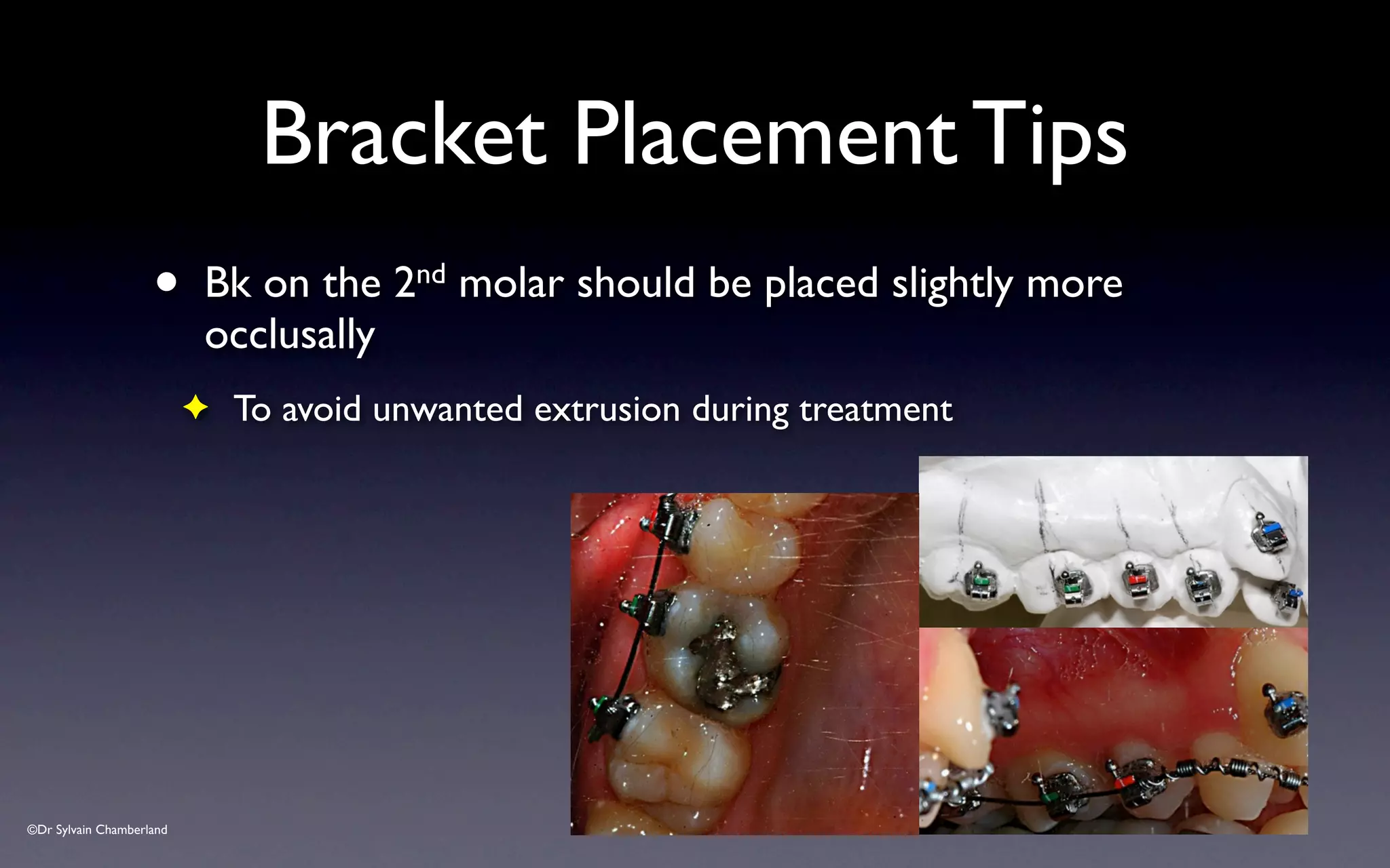 ©Dr Sylvain Chamberland
• Bk on the 2nd molar should be placed slightly more
occlusally
✦ To avoid unwanted extrusion during treatment
Bracket Placement Tips
 