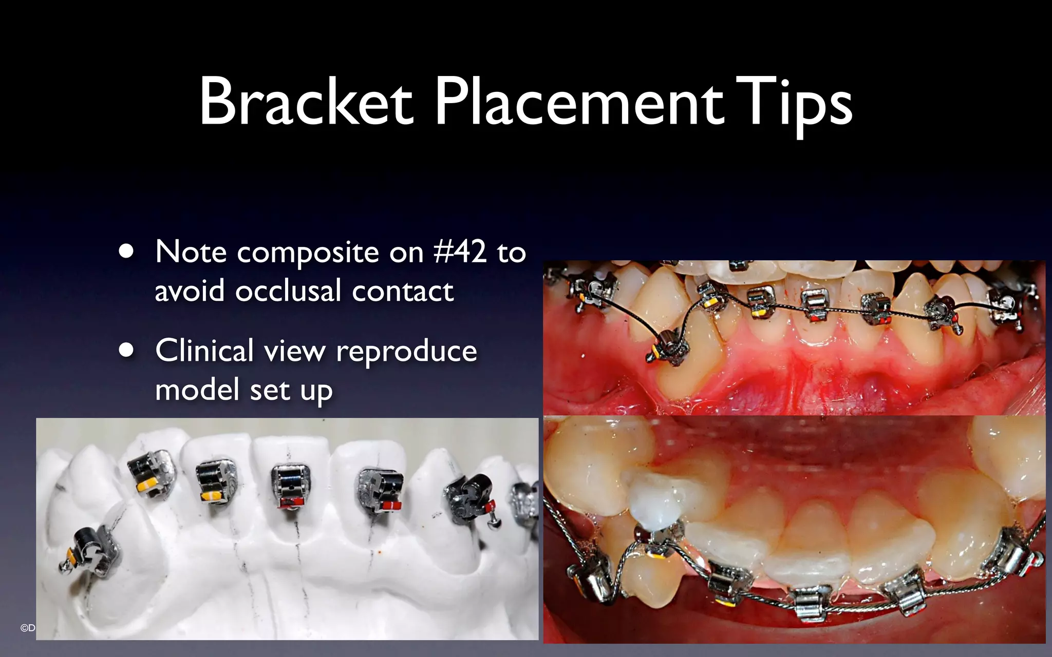 ©Dr Sylvain Chamberland
• Note composite on #42 to
avoid occlusal contact
• Clinical view reproduce
model set up
Bracket Placement Tips
 