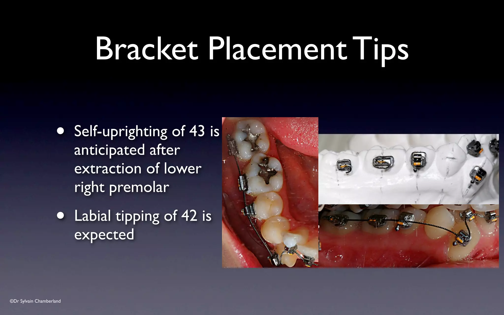 ©Dr Sylvain Chamberland
• Self-uprighting of 43 is
anticipated after
extraction of lower
right premolar
• Labial tipping of 42 is
expected
Bracket Placement Tips
 