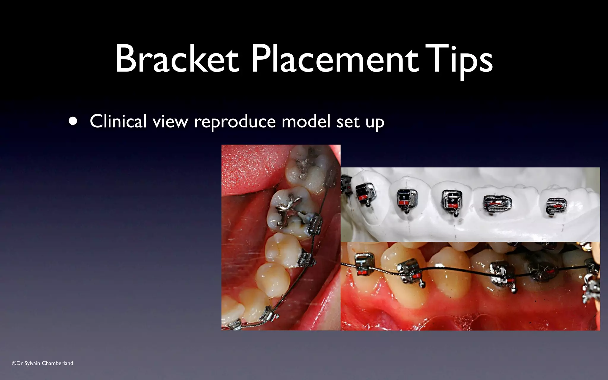 ©Dr Sylvain Chamberland
• Clinical view reproduce model set up
Bracket Placement Tips
 